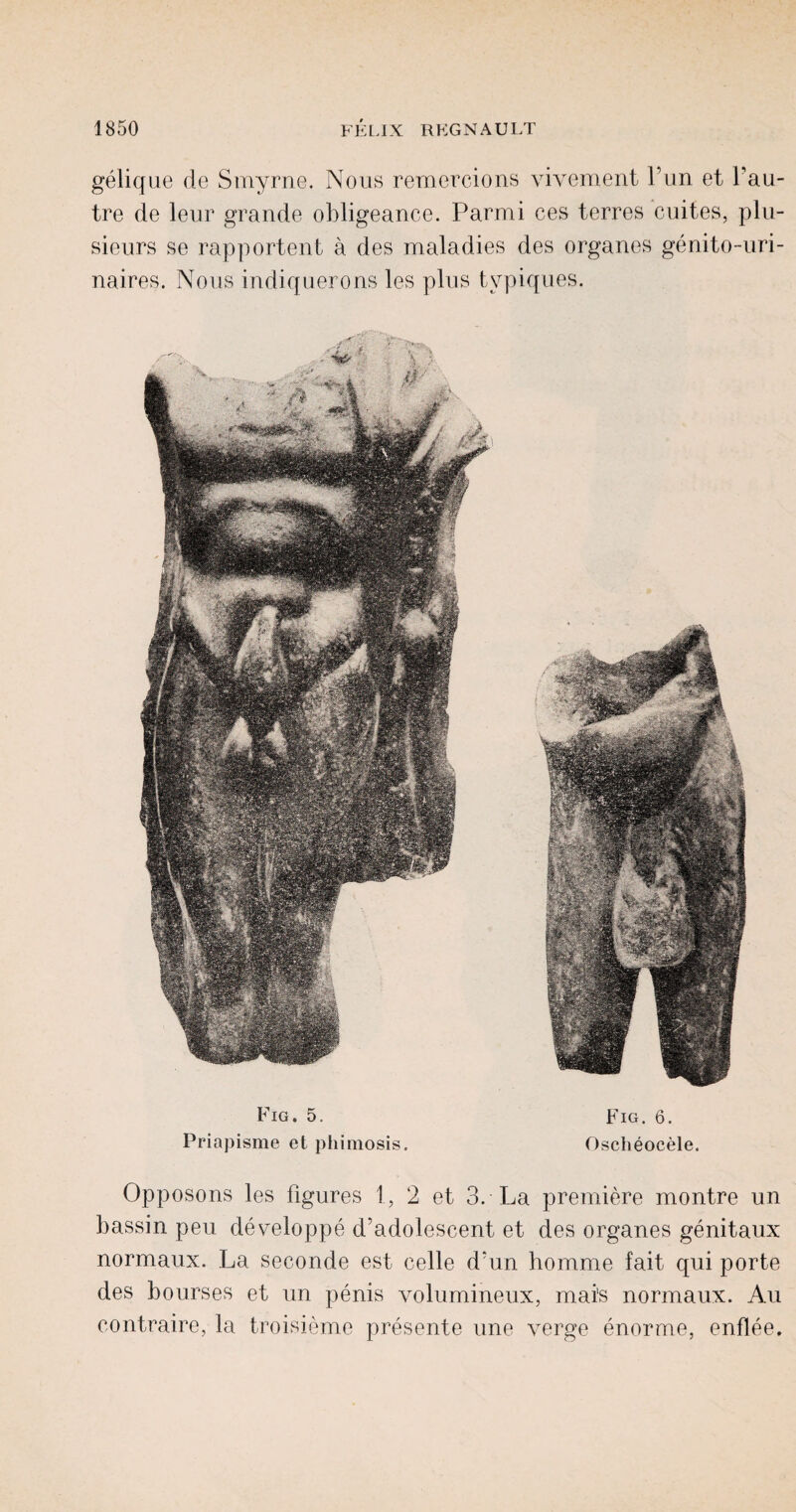 gelique de Smyrne. Nous remercions vivement Tun et fau- tre de leur grande obligeance. Parmi ces terres cuites, plu- sieurs se rapportent a des maladies des organes genito-uri- naires. Nous indiquerons les plus tvpiques. Fig. 5. Fig. 6. Priapisme et phimosis. Oscheocele. Opposons les figures 1, 2 et 3. La premiere montre un bassin peu developpe d’adolescent et des organes genitaux normaux. La seconde est. celle d'un homme fait qui porte des bourses et un penis volumineux, mai's normaux. Au contraire, la troisieme presente une verge enorme, enflee.