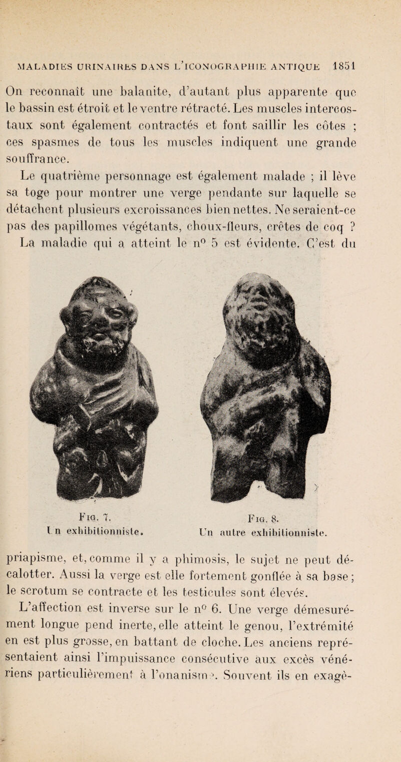 On reconnait une balanite, d’autant plus apparente quc le bassin est etroit et le ventre retracte. Les muscles intercos- taux sont egalement contractes et font saillir les cotes ; oes spasmes de tous les muscles indiquent une grande souff ranee. Le quatrieme personnage est egalement malade ; il leve sa toge pour montrer une verge pendante sur laquelle se detachent plusieurs excroissances biennettes. Ne seraient-ce pas des papillomes vegetants, cboux-fleurs, cretes de coq ? La maladie qui a atteint le n° 5 est evidente. C'est du Fig. 7. I n exhibitionnisle Fig. 8. Un autre exliibitionnisle priapisme, et, comme il y a phimosis, le sujet ne peut de- calotter. Aussi la verge est elle fortement gonflee a sa base; le scrotum se contracte et les testicules sont eleves. L’affection est inverse sur le n° 6. Une verge demesure- ment longue pend inerte,elle atteint le genou, Fextremite en est plus grosse, en battant de cloche. Les anciens repre- sentaient ainsi Fimpuissance consecutive aux exces vene- riens particulierement a Fonanisrn \ Souvent ils en exage-