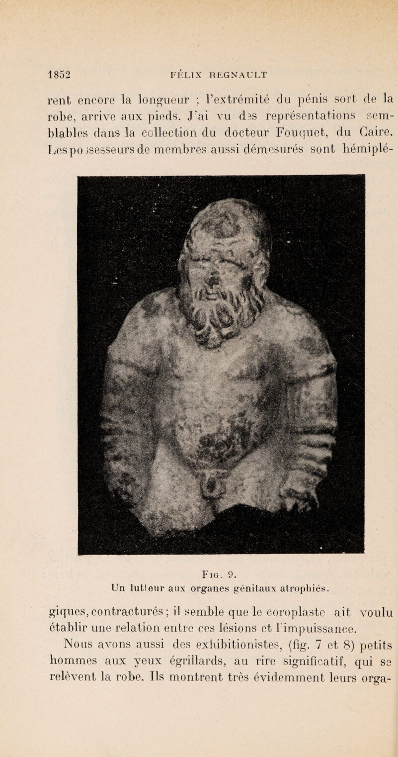 rent encore la longueur ; l’extremite du penis sort de la robe, arrive aux pieds. J'ai vu d^s representations sem- blables dans la collection du docteur Fouquet, du Gaire. Lespo jsesseurs de membres aussi demesures sont hemiple- Fig. 9. Un lutleur aux organes genitaux atrophies. giques,contractures; il semble que le coroplaste ait voulu etablir une relation entre ces lesions et rimpuissance. Nous avons aussi des exiiibitionistes, (fig. 7 et 8) petits hommes aux yeux egriilards, au rire significatif, qui se relevent la robe. Us montrent tres evidemment leurs orga-