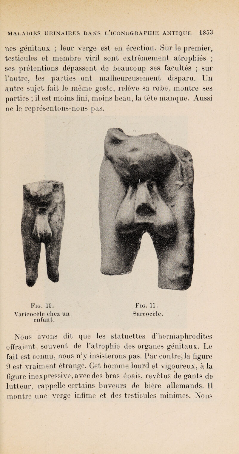 nes genitaux ; leur verge est en erection. Sur le premier, testicules et membre viril sont extremement atrophies ; ses pretentions depassent de beaucoup ses facultes ; sur l’autre, les parties ont malheureusement disparu. Un autre sujet fait le meme geste, releve sa robe, montre ses parties ; il est moins fmi, moins beau, la tete manque. Aussi ne le representons-nous pas. Fig. 10. Fig. 11. Varicocele cliez un Sarcocele. enfant. Nous avons dit que les statuettes d’hermapbrodites offraient souvent de l’atrophie des organes genitaux. Le fait est connu, nous n’y insisterons pas. Par contre,la figure 9 est vraiment etrange. Get homme lourd et vigoureux, a la figure inexpressive, avec des bras epais, revetus de gants de lutteur, rappelle certains buveurs de biere allemands. II montre une verge infime et des testicules minimes. Nous