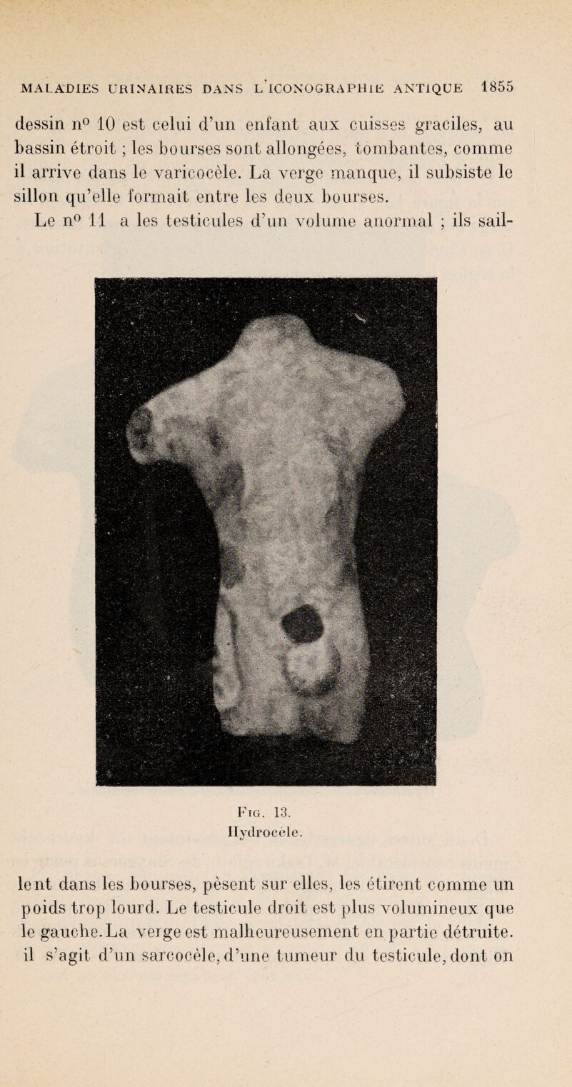 dessin n° 10 est celui d’un enfant aux cuisses graciles, au bassin etroit; les bourses sont allongees, tombantes, comme il arrive dans le varicocele. La verge manque, il subsiste le sillon qu’elle formait entre les deux bourses. Le n° 11 a les testicules d’un volume anormal ; ils sail- Ftg. 13. Hydrocele. lent dans les bourses, pesent sur elles, les etirent comme un poids trop lourd. Le testicule droit est plus volumineux que le gauche. La verge est malheureusement en partie detruite. il s’agit d’un sarcocele,d’ime tumeur du testicule, dont on