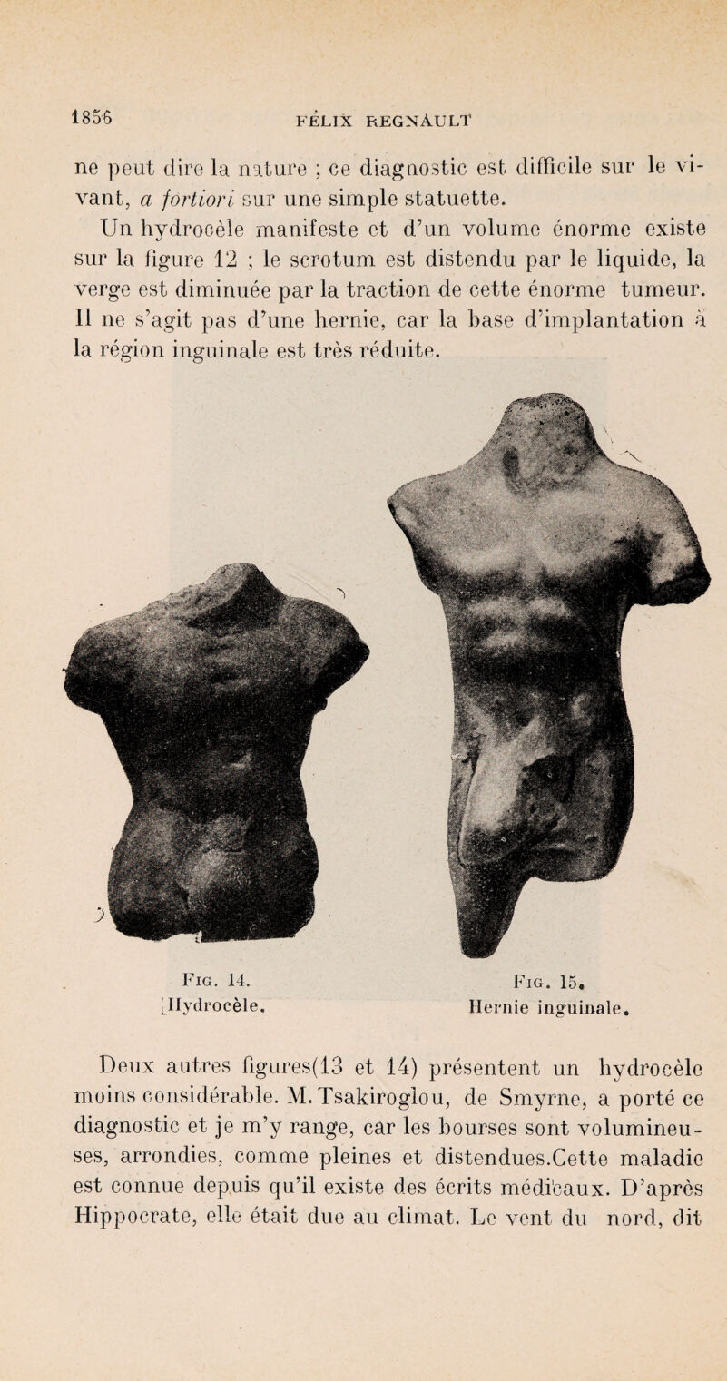 ne peut dire la nature ; ce diagnostic est difficile sur le vi- vant, a fortiori sur une simple statuette. Un hydrocele manifeste et d’un volume enorme existe sur la figure 12 ; le scrotum est distendu par le liquide, la verge est diminuee par la traction de cette enorme tumeur. II ne s’agit pas d’une liernie, car la base d'implantation a la region inguinale est tres reduite. Fig. 14. Fig. 15. :Hydrocele. Hernie inguinale. Deux autres figures(13 et 14) presentent un hydrocele moins considerable. M. Tsakiroglou, de Smyrne, a porte ce diagnostic et je m’y range, car les bourses sont volumineu- ses, arrondies, comme pleines et distendues.Cette maladie est connue depuis qu’il existe d.es ecrits medi'caux. D’apres Hippocrate, elle etait due au climat. Le vent du nord, dit