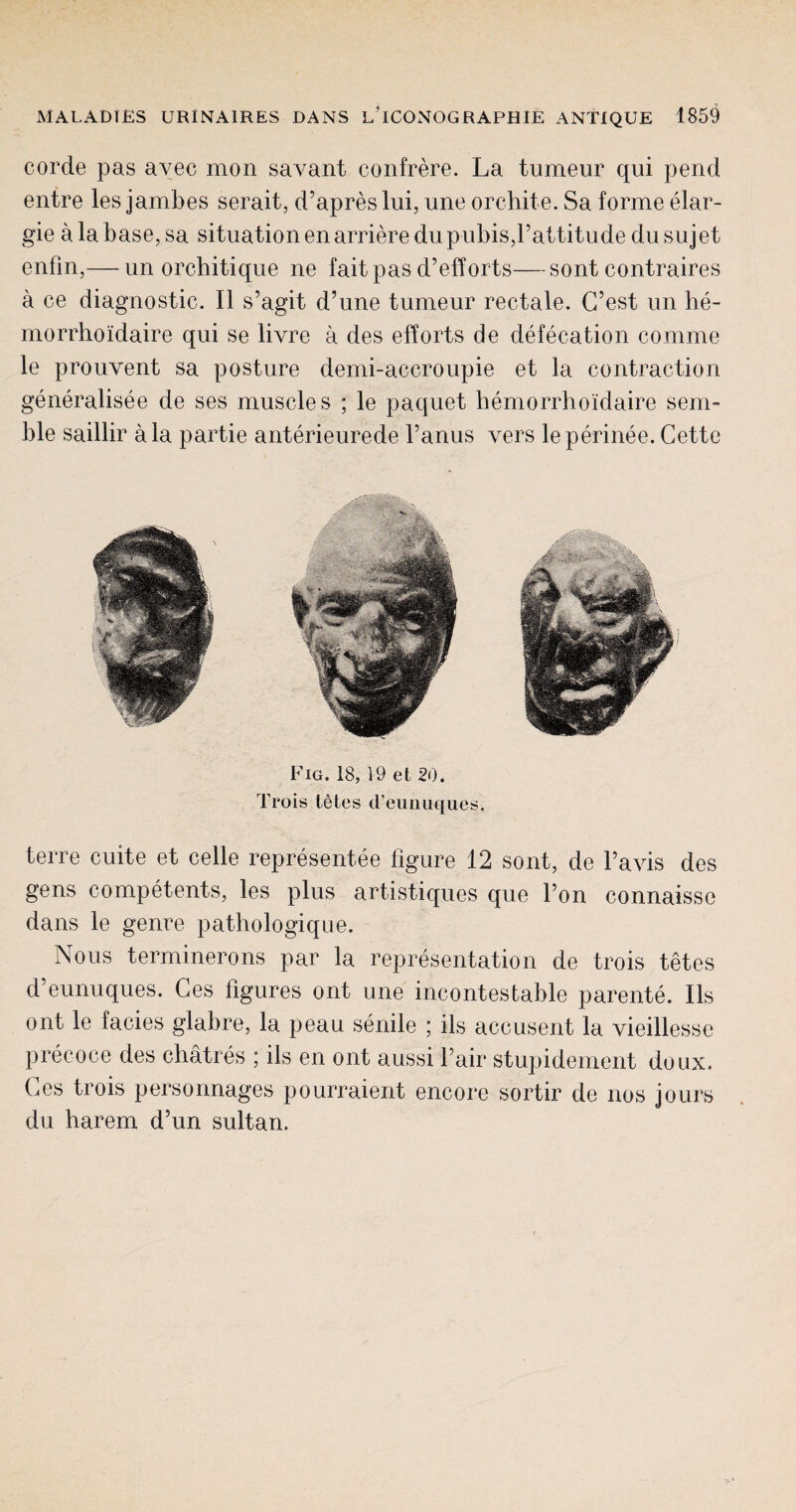 corde pas avec mon savant confrere. La tumeur qui pend entre les jambes serait, d’apreslui, une orchite. Sa forme elar- gie a la base, sa situation enarrieredu pubis,Pattitude dusujet enfm,— un orchitique ne fait pas d’efforts— sont contraires a ce diagnostic. II s’agit d’une tumeur rectale. G’est un be- morrhoidaire qui se livre a des efforts de defecation comme le prouvent sa posture demi-accroupie et la contraction generalisee de ses muscles ; le paquet hemorrhoidaire sem- ble saillir a la partie anterieurede Panus vers le perinee. Cette Fig. 18, 19 et 20. Trois I5tes d’eunuques. terre cuite et celle representee figure 12 sont, de Pavis des gens competents, les plus artistiques que l’on connaisse dans le genre pathologique. Nous terminerons par la representation de trois tetes d’eunuques. Ces figures ont une incontestable parente. Ils ont le facies glabre, la peau senile ; ils accusent la vieillesse precoce des chatres ; ils en ont aussi Pair stupidement doux. Ces trois personnages pourraient encore sortir de nos jours du harem d’un sultan.