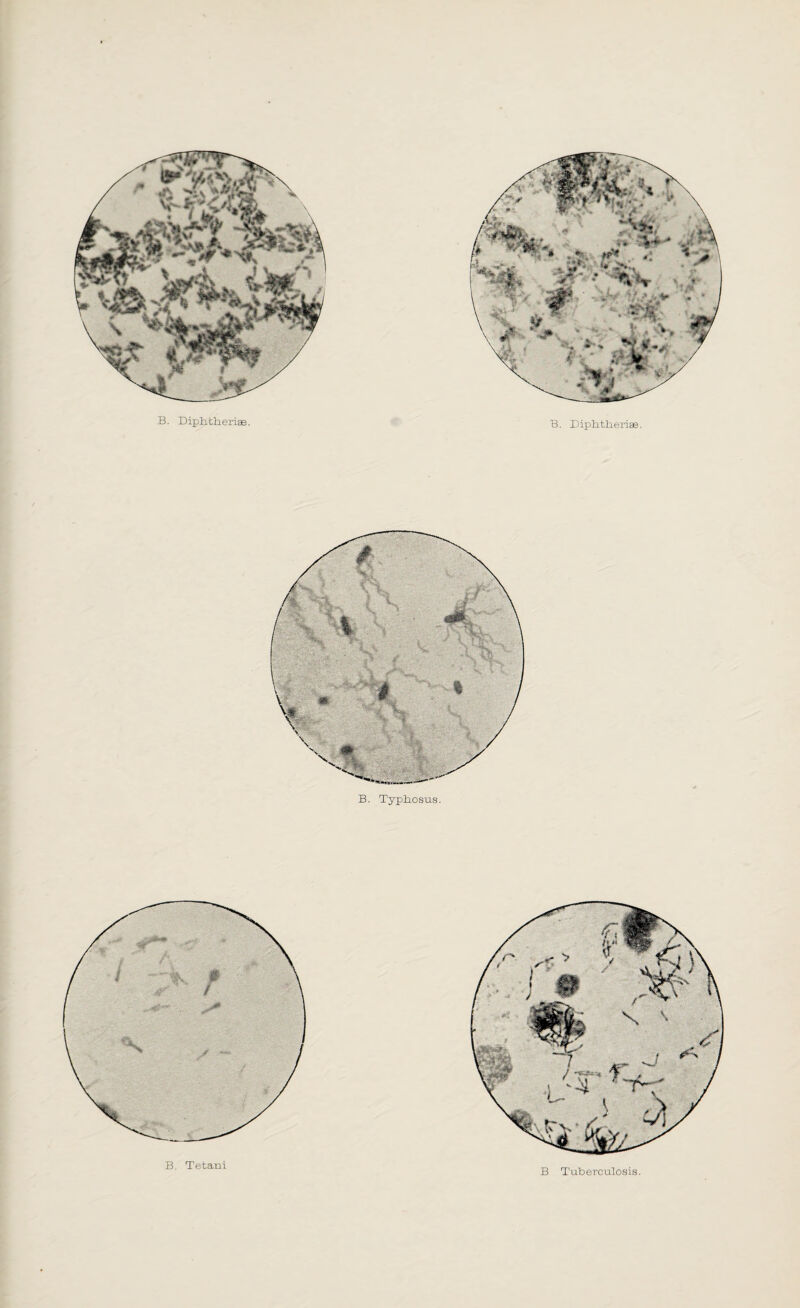 B. Tetani B Tuberculosis.