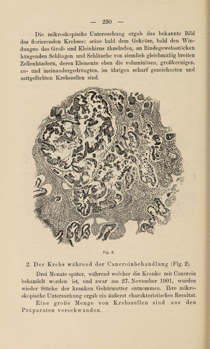 Die mikroskopische Untersuchung ergab das bekannte Bild des florierenden Krebses: seine bald dem Gekröse, bald den Win¬ dungen des Groß- und Kleinhirns ähnelnden, an Bindegewebsstöcken hängenden Schlingen und Schläuche von ziemlich gleichmäßig breiten Zellenbändern, deren Elemente eben die voluminösen, großkernigen, an- und ineinandergedrängten, im übrigen scharf gezeichneten und sattgefärbten Krebszellen sind. Fig. 2. 2. D er Krebs während der Cancroinbehandlung (Fig. 2). Drei Monate später, während welcher die Kranke mit Cancroin behandelt worden ist, und zwar am 27. November 1901, wurden wieder Stücke der kranken Gebärmutter entnommen. Ihre mikro¬ skopische Untersuchung ergab ein äußerst charakteristisches Resultat. Eine große Menge von Krebszellen sind aus den Präparaten verschwunden.