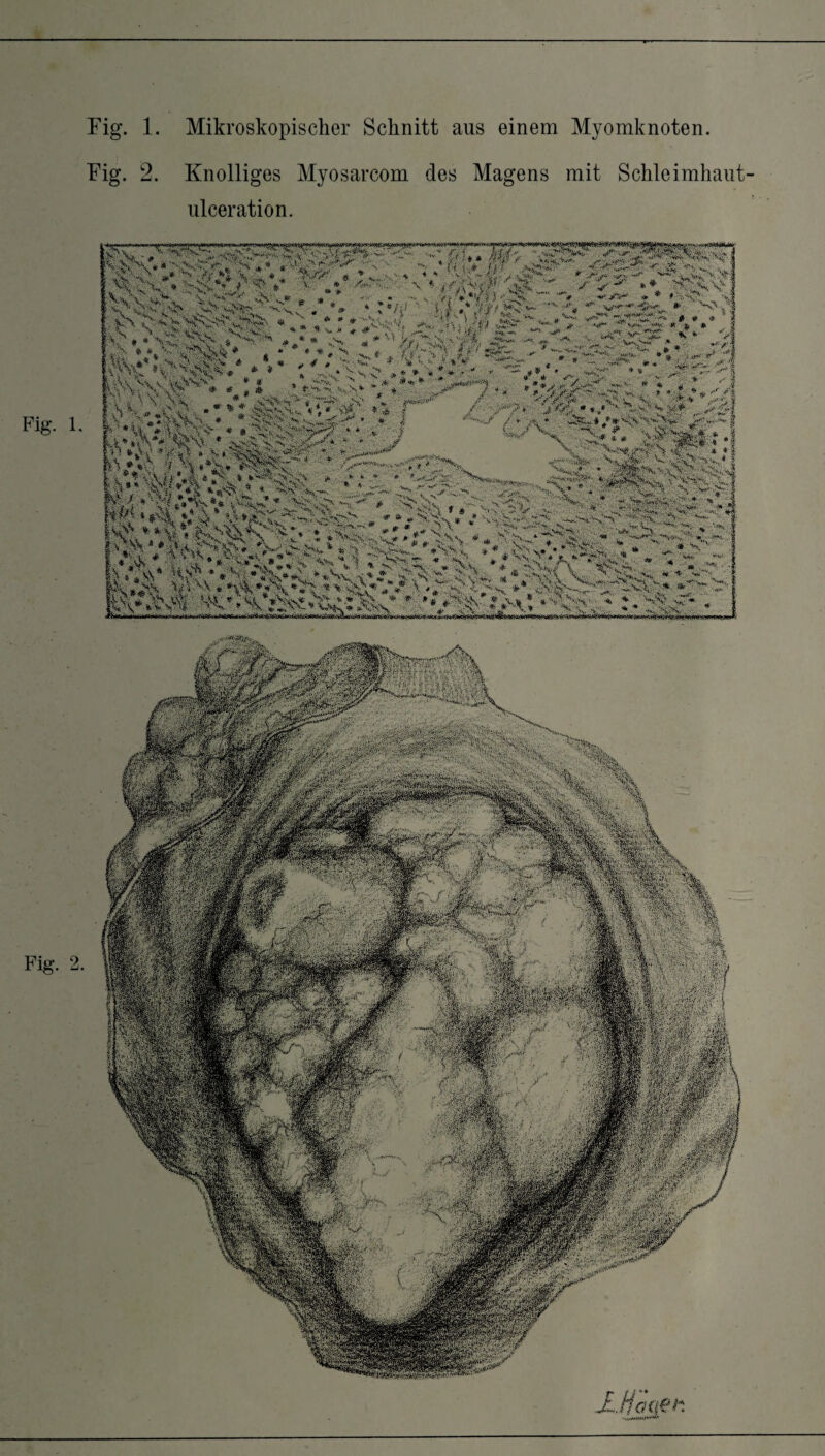 Fig. 1. Mikroskopischer Schnitt aus einem Myomknoten. Fig. 2. Knolliges Myosarcom des Magens mit Schleimhaut- ulceration. Fig. 1