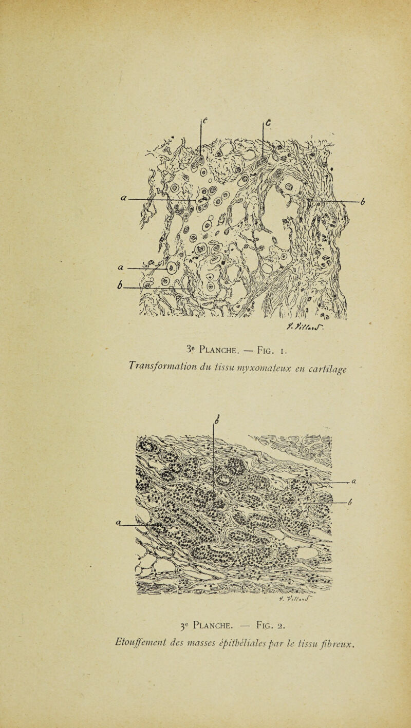 c 3e Planche. — Fig. i. Transformation du tissu myxomateux en cartilage è y. y//A,,cr y Planche. — Fig. 2. Etouffement des masses épithéliales par le tissu fibreux.