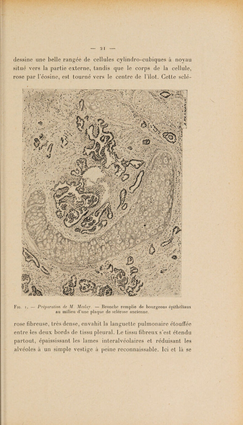 dessine une belle rangée de cellules cylindro-cubiques à noyau situé vers la partie externe, tandis que le corps de la cellule, rose par l'éosine, est tourné vers le centre de 1 îlot. Cette scié- % ' V - - - ** . Fig. i. — Préparation de M. Meslay. — Bronche remplie de bourgeons épithéliaux au milieu d'une plaque de sclérose ancienne. rose fibreuse, très dense, envahit la languette pulmonaire étouffée entre les deux bords de tissu pleural. Le tissu fibreux s'est étendu partout, épaississant les lames interalvéolaires et réduisant les alvéoles à un simple vestige à peine reconnaissable. Ici et là se