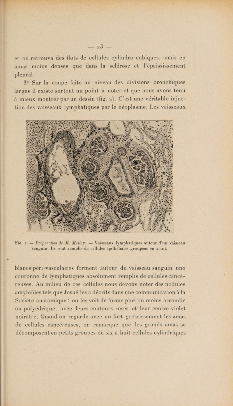 et on retrouva des îlots de cellules eylindro-cubiques, mais en amas moins denses que dans la sclérose et l'épaississement 3° Sur la coupe faite au niveau des divisions bronchiques larges il existe surtout nu point à noter et que nous avons tenu à mieux montrer par un dessin (fig-. 2). C'est une véritable injec¬ tion des vaisseaux lymphatiques par le néoplasme. Les vaisseaux Fig. 2. — Préparation de M. Meslay. — Vaisseaux lymphatiques autour d’un vaisseau sanguin. Ils sont remplis de cellules épithéliales groupées en acini. blancs péri-vasculaires forment autour du vaisseau sanguin une couronne de lymphatiques absolument remplis de cellules cancé¬ reuses. Au milieu de ces cellules nous devons noter des nodules amyloïdes tels que Josué les a décrits dans une communication à la Société anatomique ; on les voit de forme plus ou moins arrondie ou polyédrique, avec leurs contours rosés et leur centre violet noirâtre. Quand on regarde avec un fort grossissement les amas de cellules cancéreuses, on remarque que les grands amas se décomposent en petits groupes de six à huit cellules cylindriques