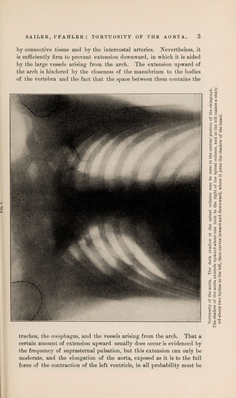by connective tissue and by the intercostal arteries. Nevertheless, it is sufficiently firm to prevent extension downward, in which it is aided by the large vessels arising from the arch. The extension upward of the arch is hindered by the closeness of the manubrium to the bodies of the vertebra and the fact that the space between them contains the trachea, the oesophagus, and the vessels arising from the arch. That a certain amount of extension upward usually does occur is evidenced by the frequency of suprasternal pulsation, but this extension can only be moderate, and the elongation of the aorta, exposed as it is to the full force of the contraction of the left ventricle, in all probability must be Tortuosity of the aorta. The dark shadow ot the spinal column maybe seen in the central portion of the skiagraph. The shadow of the aorta extends upward about one inch to the right of the spinal column, and at the left makes a sharp nd about two inches to the left, then curves inward and downward, where it joins the shadow of the heart.