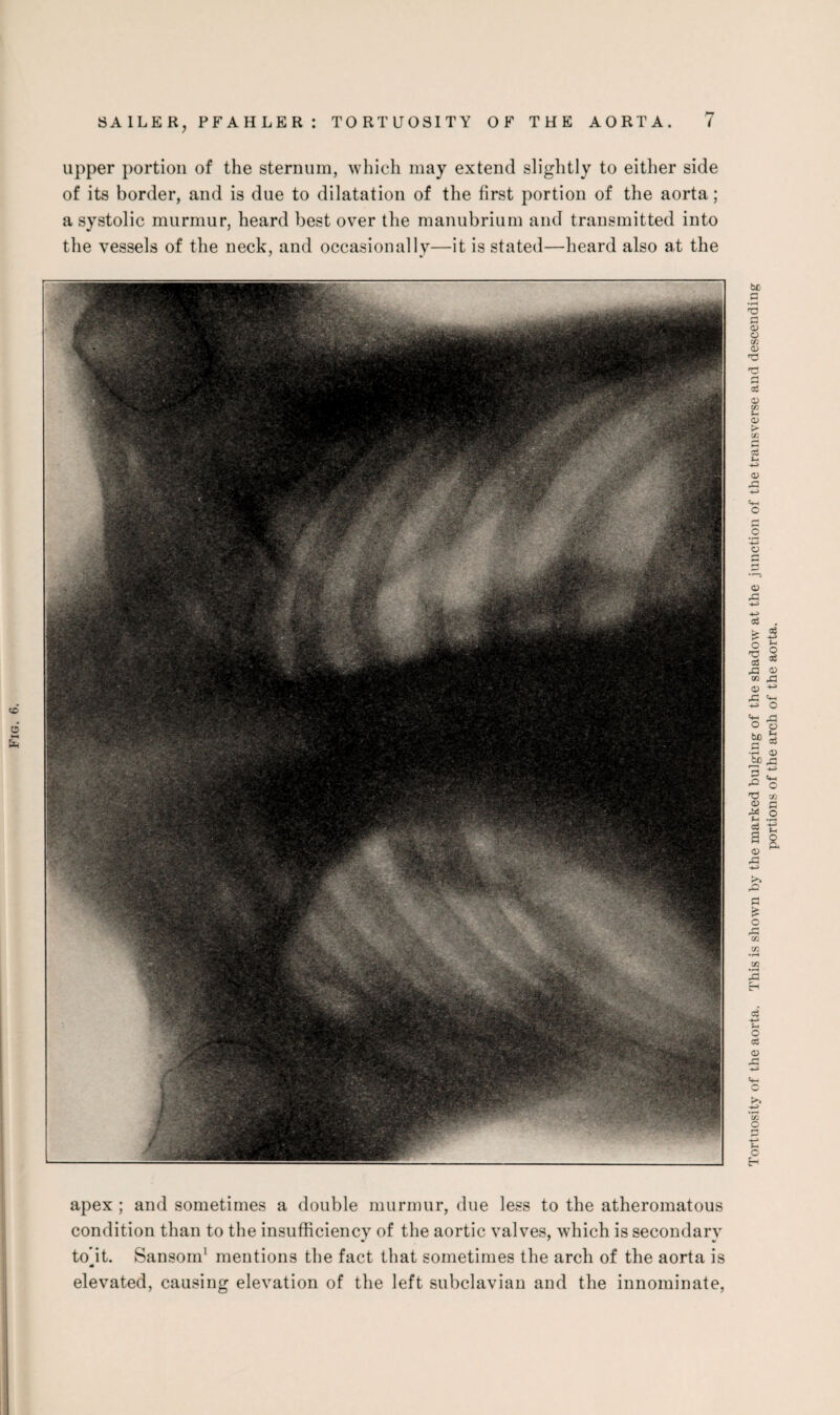 upper portion of the sternum, which may extend slightly to either side of its border, and is due to dilatation of the first portion of the aorta; a systolic murmur, heard best over the manubrium and transmitted into the vessels of the neck, and occasionally—it is stated—heard also at the apex ; and sometimes a double murmur, due less to the atheromatous condition than to the insufficiency of the aortic valves, which is secondary to’it. Sansorn1 mentions the fact that sometimes the arch of the aorta is M elevated, causing elevation of the left subclavian and the innominate, Tortuosity of the aorta. This is shown by the marked bulging of the shadow at the junction of the transverse and descending
