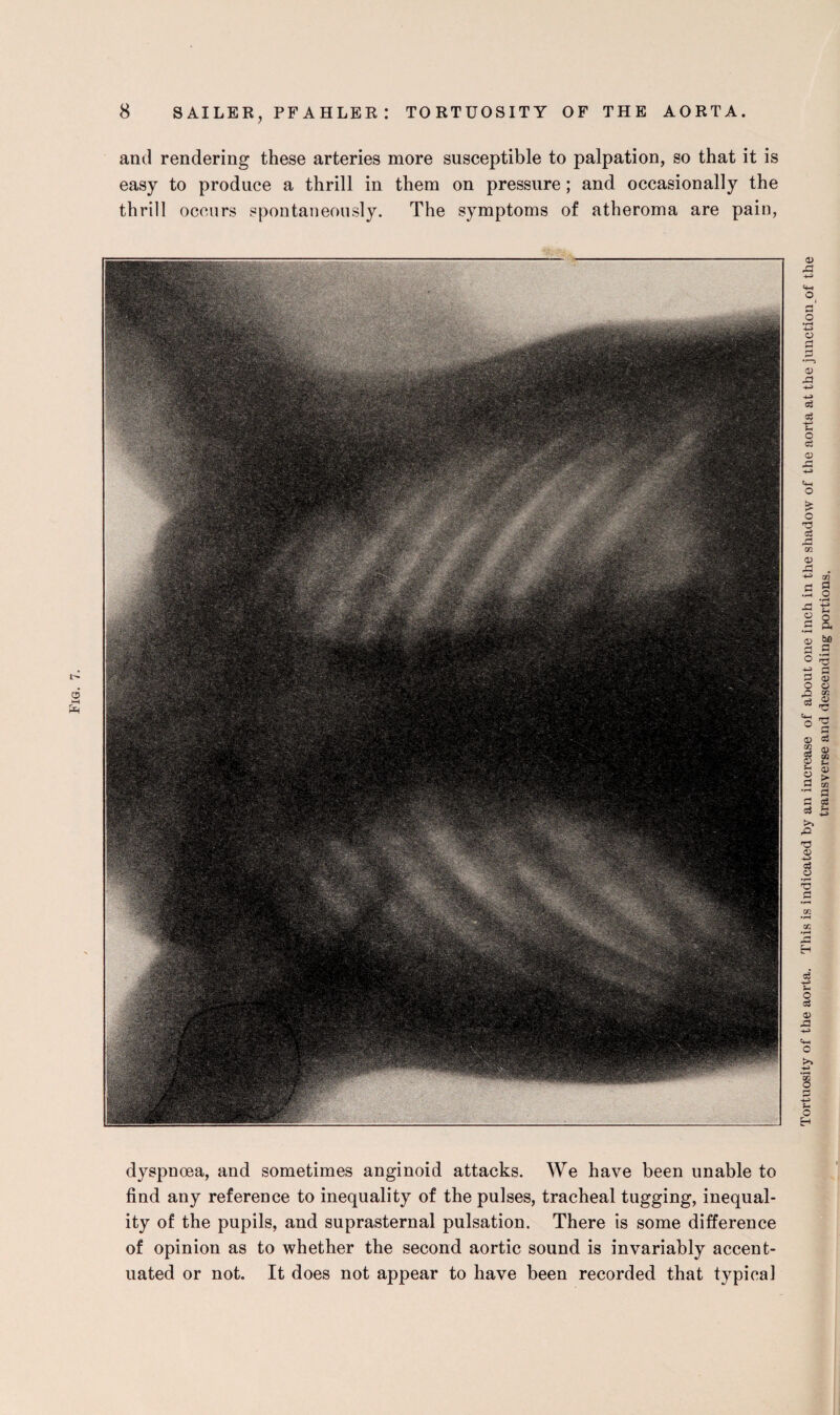 and rendering these arteries more susceptible to palpation, so that it is easy to produce a thrill in them on pressure; and occasionally the thrill occurs spontaneously. The symptoms of atheroma are pain, dyspnoea, and sometimes anginoid attacks. We have been unable to find any reference to inequality of the pulses, tracheal tugging, inequal¬ ity of the pupils, and suprasternal pulsation. There is some difference of opinion as to whether the second aortic sound is invariably accent¬ uated or not. It does not appear to have been recorded that typical transverse and descending portions.