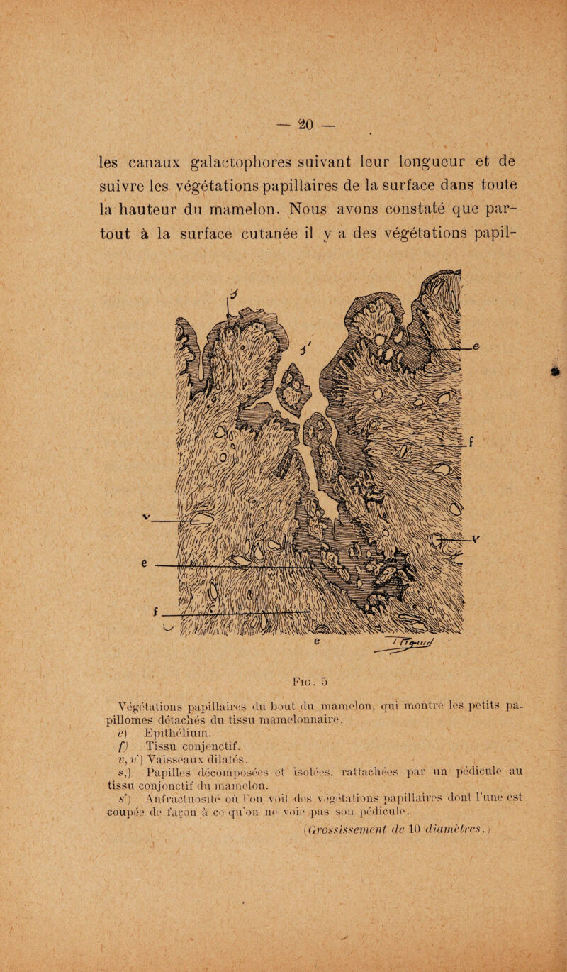 les canaux galactophores suivant leur longueur et de suivre les végétations papillaires de la surface dans toute la hauteur du mamelon. Nous avons constaté que par¬ tout à la surface cutanée il y a des végétations papil- Fig. 5 Végétations papillaires du bout du mamelon, qui montre les petits pa- pillomes détachés du tissu mamelonnaire. c) Epithélium. f) Tissu conjonctif. v,v') Vaisseaux dilatés. s,) Papilles décomposées et isolées, rattachées par un pédicule au tissu conjonctif du mamelon. s’) Anfractuosité où l'on voit des végétations papillaires dont 1 une est coupée de façon à ce qu'on ne voie pas sou pédicule.