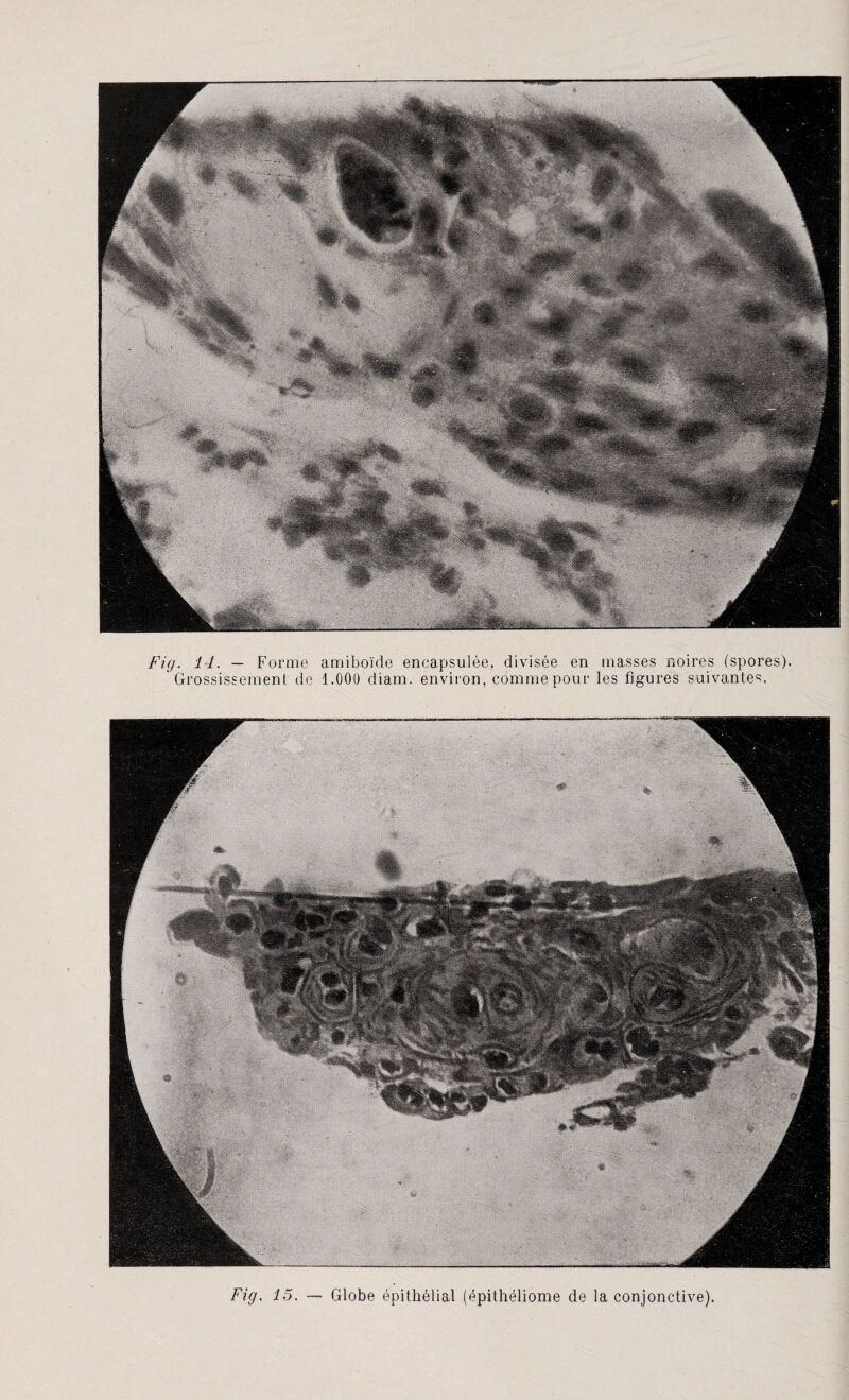 Fig. 14. — Forme amiboïde encapsulée, divisée en masses noires (spores). Grossissement de 1.000 diam. environ, comme pour les figures suivantes. Fig. 15 Globe épithélial (épithéliome de la conjonctive)