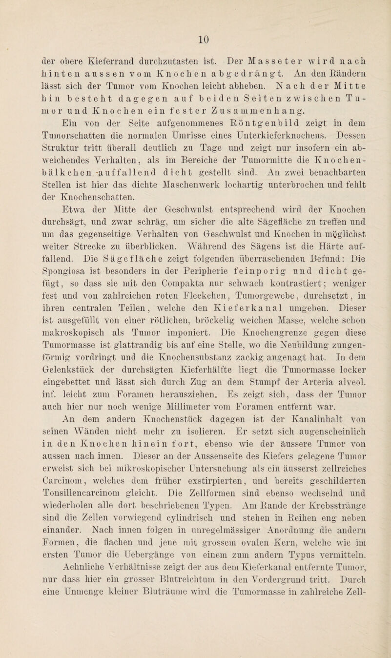 der obere Kieferrand durchzutasten ist. Der Masseter wird nach hinten aussen vom Knochen abgedrängt. An den Rändern lässt sich der Tumor vom Knochen leicht abheben. Nach der Mitte hin besteht dagegen auf beiden Seiten zwischen Tu¬ mor und Knochen ein fester Zusammenhang. Ein von der Seite aufgenommenes Röntgenbild zeigt in dem Tumorschatten die normalen Umrisse eines Unterkieferknochens. Dessen Struktur tritt überall deutlich zu Tage und zeigt nur insofern ein ab¬ weichendes Verhalten, als im Bereiche der Tumormitte die Knoclien- bälkchen'auffallend dicht gestellt sind. An zwei benachbarten Stellen ist hier das dichte Maschenwerk lochartig unterbrochen und fehlt der Knochenschatten. Etwa der Mitte der Geschwulst entsprechend wird der Knochen durchsägt, und zwar schräg, um sicher die alte Sägefläche zu treffen und um das gegenseitige Verhalten von Geschwulst und Knochen in möglichst weiter Strecke zu überblicken. Während des Sägens ist die Härte auf¬ fallend. Die Sägefläche zeigt folgenden überraschenden Befund: Die Spongiosa ist besonders in der Peripherie feinporig und dicht ge¬ fügt , so dass sie mit den Compakta nur schwach kontrastiert; weniger fest und von zahlreichen roten Fleckchen, Tumorgewebe, durchsetzt, in ihren centralen Teilen, welche den Kieferkanal umgeben. Dieser ist ausgefüllt von einer rötlichen, bröckelig weichen Masse, welche schon makroskopisch als Tumor imponiert. Die Knochengrenze gegen diese Tumormasse ist glattrandig bis auf eine Stelle, wo die Neubildung zungen¬ förmig vordringt und die Knochensubstanz zackig angenagt hat. In dem Gelenkstück der durchsägten Kieferhälfte liegt die Tumormasse locker eingebettet und lässt sich durch Zug an dem Stumpf der Arteria alveol. inf. leicht zum Foramen herausziehen. Es zeigt sich, dass der Tumor auch hier nur noch wenige Millimeter vom Foramen entfernt war. An dem andern Knochenstück dagegen ist der Kanalinhalt Von seinen Wänden nicht mehr zu isolieren. Er setzt sich augenscheinlich in den Knochen hinein fort, ebenso wie der äussere Tumor von aussen nach innen. Dieser an der Aussenseite des Kiefers gelegene Tumor erweist sich bei mikroskopischer Untersuchung als ein äusserst zellreiches Carcinom, welches dem früher exstirpierten, und bereits geschilderten Tonsillencarcinoin gleicht. Die Zellformen sind ebenso wechselnd und wiederholen alle dort beschriebenen Typen. Am Rande der Krebsstränge sind die Zellen vorwiegend cylindriscli und stehen in Reihen eng neben einander. Nach innen folgen in unregelmässiger Anordnung die andern Formen, die flachen und jene mit grossem ovalen Kern, welche wie im ersten Tumor die Uebergänge von einem zum andern Typus vermitteln. Aehnliche Verhältnisse zeigt der aus dem Kieferkanal entfernte Tumor, nur dass hier ein grosser Blutreichtum in den Vordergrund tritt. Durch eine Unmenge kleiner Bluträume wird die Tumormasse in zahlreiche Zell-