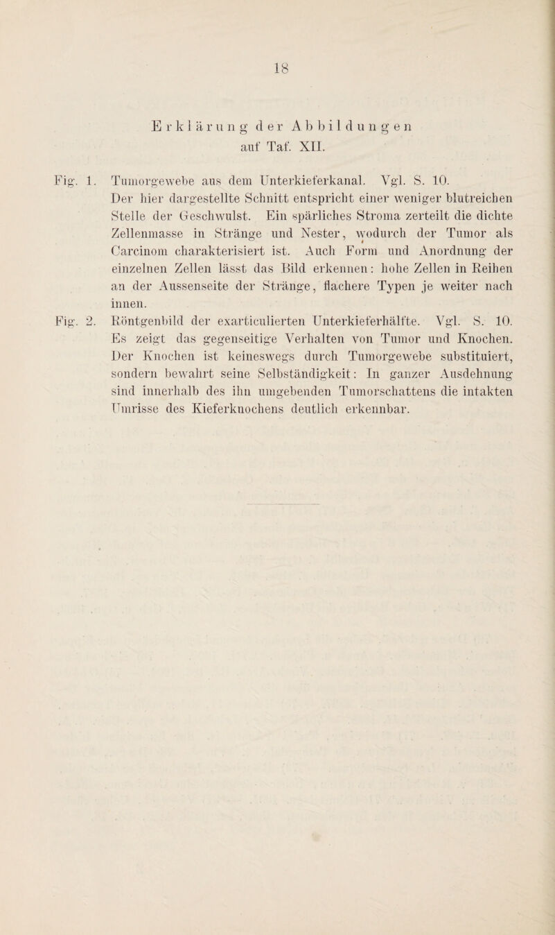 Erklär u n g de r A b bildunge n auf Taf. XII. Fig. 1. Tumorgewebe aus dem Unterkieferkanal. Vgl. S. 10. Der hier dargestellte Schnitt entspricht einer weniger blutreichen Stelle der Geschwulst. Ein spärliches Stroma zerteilt die dichte Zellenmasse in Stränge und Nester, wodurch der Tumor als Carcinom charakterisiert ist. Auch Form und Anordnung der einzelnen Zellen lässt das Bild erkennen: hohe Zellen in Reihen an der Aussenseite der Stränge, flachere Typen je weiter nach innen. Fig. 2. Röntgenbild der exarticulierten Unterkieferhälfte. Vgl. S. 10. Es zeigt das gegenseitige Verhalten von Tumor und Knochen. Der Knochen ist keineswegs durch Tumorgewebe substituiert, sondern bewahrt seine Selbständigkeit: In ganzer Ausdehnung sind innerhalb des ihn umgebenden Tumorschattens die intakten Umrisse des Kieferknochens deutlich erkennbar.