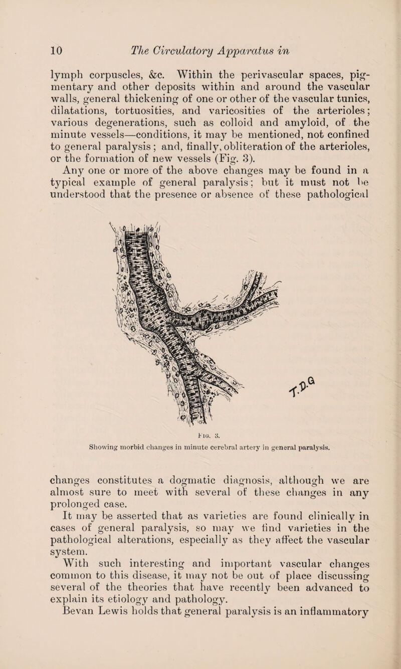 lymph corpuscles, &c. Within the perivascular spaces, pig¬ mentary and other deposits within and around the vascular walls, general thickening o£ one or other of the vascular tunics, dilatations, tortuosities, and varicosities of the arterioles; various degenerations, such as colloid and amyloid, of the minute vessels—conditions, it may be mentioned, not confined to general paralysis; and, finally, obliteration of the arterioles, or the formation of new vessels (Fig. 3). Any one or more of the above changes may be found in a typical example of general paralysis; but it must not be understood that the presence or absence of these pathological changes constitutes a dogmatic diagnosis, although we are almost sure to meet with several of these changes in any prolonged case. It may be asserted that as varieties are found clinically in cases of general paralysis, so may we find varieties in the pathological alterations, especially as they affect the vascular system. With such interesting and important vascular changes common to this disease, it may not be out of place discussing several of the theories that have recently been advanced to explain its etiology and pathology. Bevan Lewis holds that general paralysis is an inflammatory