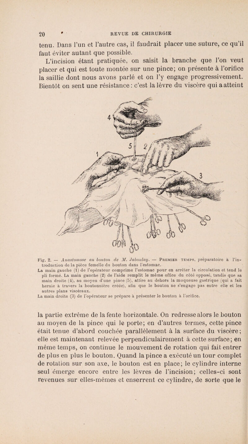 tenu. Dans l’un et l’autre cas, il faudrait placer une suture, ce qu’il faut éviter autant que possible. L’incision étant pratiquée, on saisit la branche que l’on veut placer et qui est toute montée sur une pince; on présente à l’orifice la saillie dont nous avons parié et on l’y engage progressivement. Bientôt on sent une résistance : c’est la lèvre du viscère qui a atteint Fig. 2. — Anastomose au bouton de M. Jaboulay. — Premier temps, préparatoire à l’in¬ troduction de la pièce femelle du bouton dans l’estomac. La main gauche (1) de l’opérateur comprime l’estomac pour en arrêter la circulation et tend le pli formé. La main gauche (2) de l’aide remplit le même office du côté opposé, tandis que sa main droite (4), au moyen d’une pince (5), attire au dehors la muqueuse gastrique (qui a fait hernie à travers la boutonnière créée), afin que le bouton ne s’engage pas entre elle et les autres plans viscéraux. La main droite (3) de l’opérateur se prépare à présenter le bouton à l’orifice. la partie extrême de la fente horizontale. On redresse alors le bouton au moyen de la pince qui Je porte; en d’autres termes, cette pince était tenue d’abord couchée parallèlement à la surface du viscère; elle est maintenant relevée perpendiculairement à cette surface; en même temps, on continue le mouvement de rotation qui fait entrer de plus en plus le bouton. Quand la pince a exécuté un tour complet de rotation sur son axe, le bouton est en place; le cylindre interne seul émerge encore entre les lèvres de l’incision; celles-ci sont revenues sur elles-mêmes et enserrent ce cylindre, de sorte que le