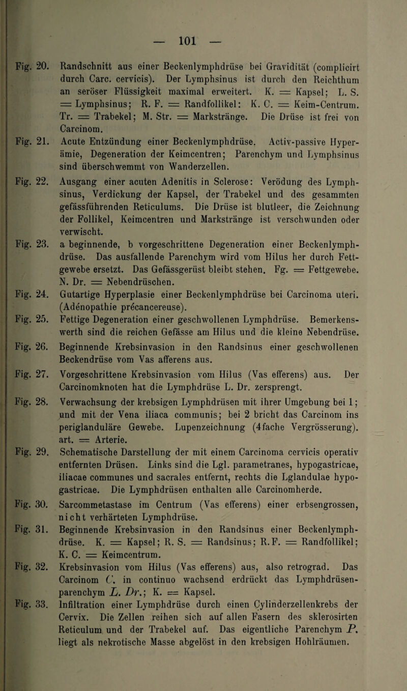 Fig. 20. Randschnitt aus einer Beckenlymphdrüse bei Gravidität (complicirt durch Care, cervicis). Der Lymphsinus ist durch den Reichthum an seröser Flüssigkeit maximal erweitert. K. — Kapsel; L. S. = Lymphsinus; R. F. = Randfollikel: K. C. = Keim-Centrum. Tr. = Trabekel; M. Str. = Markstränge. Die Drüse ist frei von Carcinom. Fig. 21. Acute Entzündung einer Beckenlymphdrüse. Activ-passive Hyper¬ ämie, Degeneration der Keimcentren; Parenchym und Lymphsinus sind überschwemmt von Wanderzellen. Fig. 22. Ausgang einer acuten Adenitis in Sclerose: Verödung des Lymph¬ sinus, Verdickung der Kapsel, der Trabekel und des gesammten gefässfiihrenden Reticulums. Die Drüse ist blutleer, die Zeichnung der Follikel, Keimcentren und Markstränge ist verschwunden oder verwischt. Fig. 23. a beginnende, b vorgeschrittene Degeneration einer Beckenlymph¬ drüse. Das ausfallende Parenchym wird vom Hilus her durch Fett¬ gewebe ersetzt. Das Gefässgeriist bleibt stehen. Fg. = Fettgewebe. N. Dr. == Nebendrüschen. Fig. 24. Gutartige Hyperplasie einer Beckenlymphdrüse bei Carcinoma uteri. (Adenopathie precancereuse). Fig. 25. Fettige Degeneration einer geschwollenen Lymphdrüse. Bemerkens¬ werth sind die reichen Gefässe am Hilus und die kleine Nebendrüse. Fig. 26. Beginnende Krebsinvasion in den Randsinns einer geschwollenen Beckendrüse vom Vas afferens aus. Fig. 27. Vorgeschrittene Krebsinvasion vom Hilus (Vas efferens) aus. Der Carcinomknoten hat die Lymphdrüse L. Dr. zersprengt. Fig. 28. Verwachsung der krebsigen Lymphdrüsen mit ihrer Umgebung bei 1; und mit der Vena iliaca communis; bei 2 bricht das Carcinom ins periglanduläre Gewebe. Lupenzeichnung (4fache Vergrösserung). art. = Arterie. Fig. 29. Schematische Darstellung der mit einem Carcinoma cervicis operativ entfernten Drüsen. Links sind die Lgl. parametranes, hypogastricae, iliacae communes und sacrales entfernt, rechts die Lglandulae hypo¬ gastricae. Die Lymphdrüsen enthalten alle Carcinomherde. Fig. 30. Sarcommetastase im Centrum (Vas efferens) einer erbsengrossen, nicht verhärteten Lymphdrüse, Fig. 31. Beginnende Krebsinvasion in den Randsinus einer Beckenlymph¬ drüse. K. = Kapsel; R. S. = Randsinus; R.F. = Randfollikel; K. C. — Keimcentrum. Fig. 32. Krebsinvasion vom Hilus (Vas efferens) aus, also retrograd. Das Carcinom C. in continuo wachsend erdrückt das Lymphdrüsen- parenchym L. Dr.; K. = Kapsel. Fig. 33. Infiltration einer Lymphdrüse durch einen Cylinderzellenkrebs der Cervix. Die Zellen reihen sich auf allen Fasern des sklerosirten Reticulum und der Trabekel auf. Das eigentliche Parenchym P. liegt als nekrotische Masse abgelöst in den krebsigen Hohlräumen.
