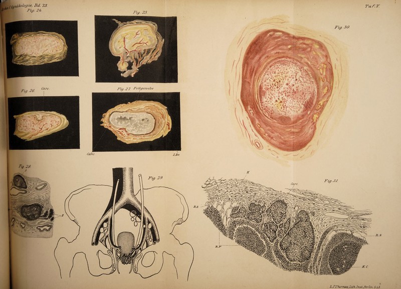 Fig. 23 Fig. 23. Ca.rc. Fig.27 Fettgewebe Care. IJDr Taf.V. K C.Ji'hüTruLs,Li2i.lTist.rßerli7i. S66