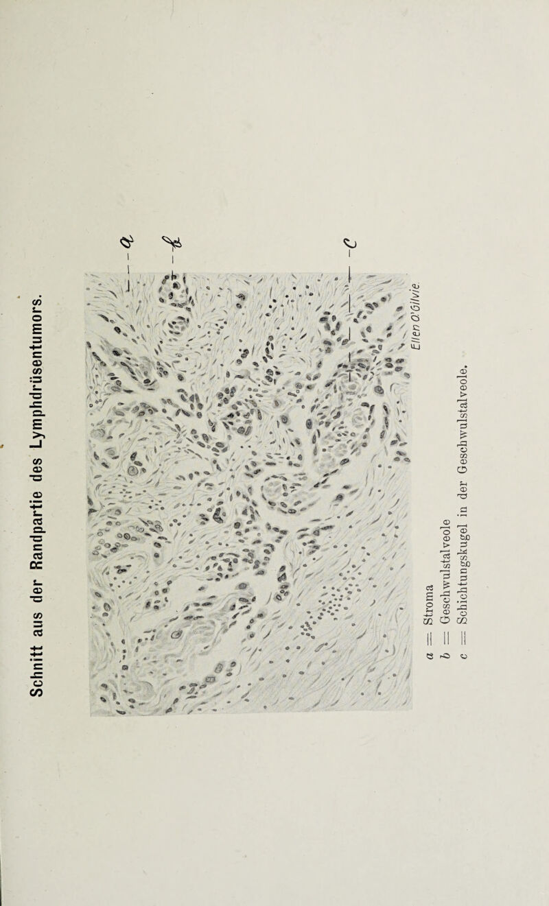 Schnitt aus der Randpartie des Lymphdrüsentumors. sj A 1 J, 1 %^ Ar ' f' - r N y i • » - . « • vv -y i %• 5/ V'*' '' •/■-■• •#< C;- •- ,'V'' - ' iA • -V&* J 1 * «* o ^ * f\> @ ^-«#4 r«> '«# ! } »' k /, . * . ** A / * c — . 4 / <*. . C. ’ A - *N'« V* v •«. -V* 0 • <* t ' “ * /* ^ • -. ' V I ■• ' *- -. * /: < r 1 • < •* A § rrf; r  » <o fl» ^ JT N' ~ 09 %* f- O j l 4jT | * # / C; y' ' * 1 %* i / «j «, •» ■ **» < *. * > s v r * «A* k» «• ' = *' j *- ' fl 4» “CS.0 - ^ ^ '•'A ' ' ‘ '-AiAj » ' .A - & A *V, • 5  ®£ .' x' ■® i? (r » - i- »“a. v ~ ^ X . »z\- “ * >***«% A? J f - r ' *» ■5‘A. Ä i ?«<!“* ^ ' * w . * 1 m -A-- ^”4” y- *, a ^ n e . -—* ' /• .j/ J ^ M w ^ JÄT1 * 9 i y ^<85 / ' * ' 6 ♦ JT- <» ,y ^ f / -y» •• -<S.® *«toÄ.P >*4 J ^SSä y.-?' $1$ C ' ° ®«>o A'*2‘ ■'*0 »3 4 V • * ./■ , .* * o O %. $ m ‘ m '\ t ^ <: * ^ * . ^ .X* “ 0& lj / m> / y / > / M «. ^ / # ^ ■ ■ V / £ 0 V ,/ '* y.\ m * «► * # Ä / » 4, « 0T « * ** SS 4» ^ *:: 9 y ^ r * ■»«*«» » » % » «8 a .„v S* ■%» , ^ »■■ % v #■ _ 0- ^ . ,, £: “ y y ’ ß .*■ - ** s? m 9» • f _ /, V('A ßf 4h/jj 4 ß * / • / » « y > r >' > / * ;■ • e -o <u Stroma Geschwulstalveole Schichtungskugel in der Geschwulstalveole.