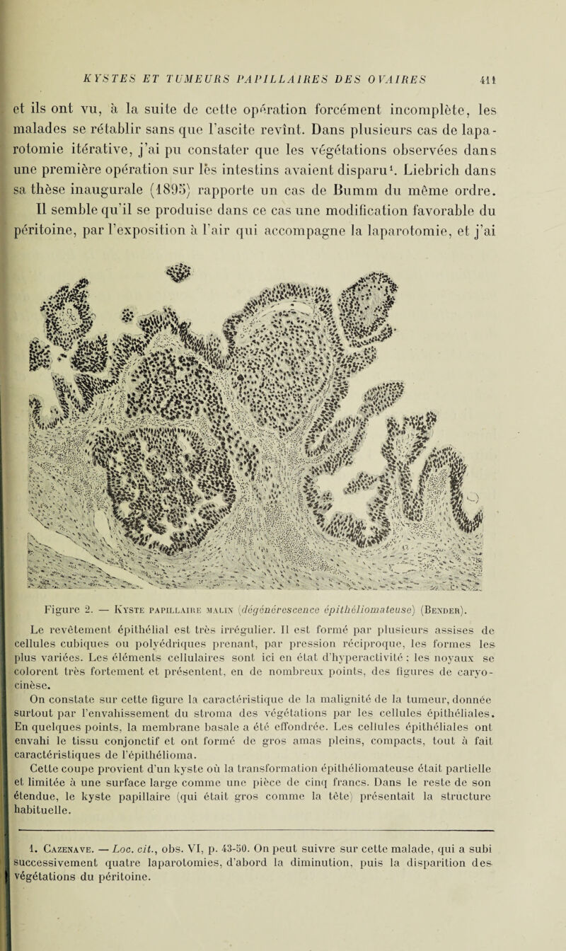et ils ont vu, à la suite de cette opération forcément incomplète, les malades se rétablir sans que l’ascite revînt. Dans plusieurs cas de lapa¬ rotomie itérative, j’ai pu constater que les végétations observées dans une première opération sur lès intestins avaient disparu1. Liebrich dans sa thèse inaugurale (1895) rapporte un cas de Bumm du même ordre. Il semble qu’il se produise dans ce cas une modification favorable du péritoine, par l’exposition à l’air qui accompagne la laparotomie, et j’ai Figure 2. — Kyste papillaire malin (dégénérescence épithéliomateuse) (Bexder). Le revêtement épithélial est très irrégulier. Il est formé par plusieurs assises de cellules cubiques ou polyédriques prenant, par pression réciproque, les formes les plus variées. Les éléments cellulaires sont ici en état d’hyperactivité ; les noyaux se colorent très fortement et présentent, en de nombreux points, des figures de caryo- cinèse. On constate sur cette figure la caractéristique de la malignité de la tumeur, donnée surtout par l’envahissement du stroma des végétations par les cellules épithéliales. En quelques points, la membrane basale a été effondrée. Les cellules épithéliales ont envahi le tissu conjonctif et ont formé de gros amas pleins, compacts, tout à fait caractéristiques de fépitliélioma. Cette coupe provient d’un kyste où la transformation épithéliomateuse était partielle et limitée à une surface large comme une pièce de cinq francs. Dans le reste de son étendue, le kyste papillaire (qui était gros comme la tête) présentait la structure habituelle. 1. Cazenave. — Loc. cit., obs. VI, p. 43-50. On peut suivre sur cette malade, qui a subi I successivement quatre laparotomies, d’abord la diminution, puis la disparition des. I végétations du péritoine.