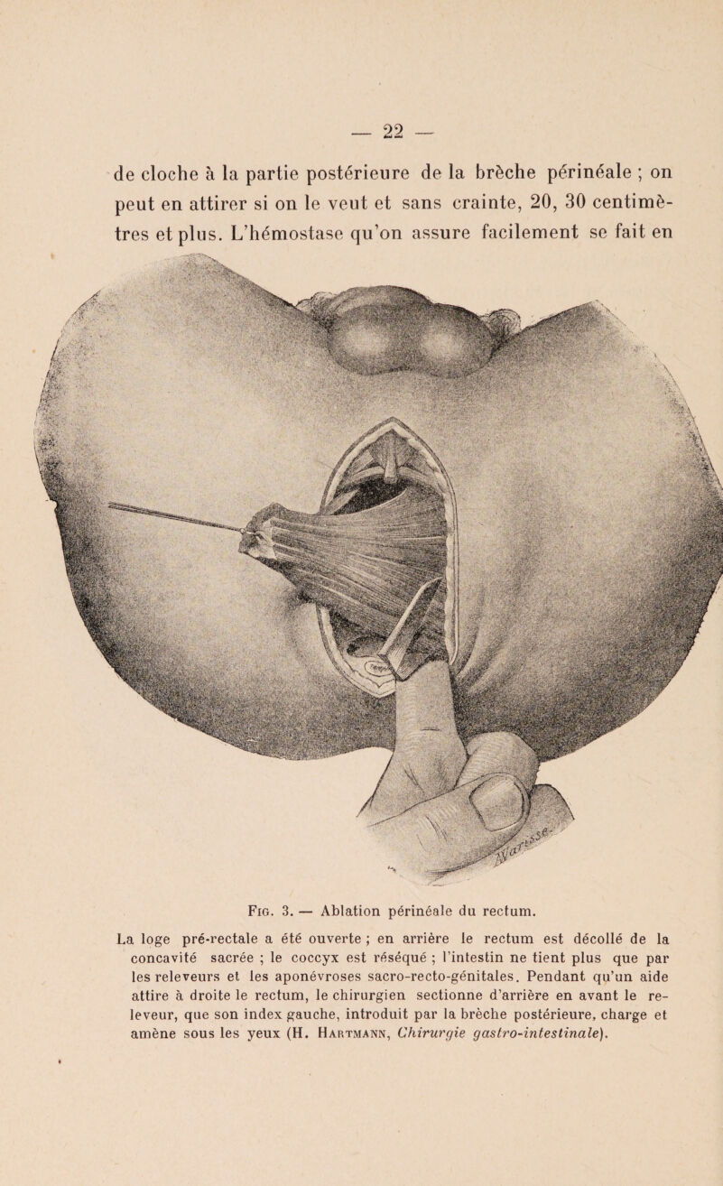 de cloche à la partie postérieure de la brèche périnéale ; on peut en attirer si on le veut et sans crainte, 20, 30 centimè¬ tres et plus. L’hémostase qu’on assure facilement se fait en Fig. 3. — Ablation périnéale du rectum. La loge pré-rectale a été ouverte ; en arrière le rectum est décollé de la concavité sacrée ; le coccyx est réséqué ; l’intestin ne tient plus que par les releveurs et les aponévroses sacro-recto-génitales. Pendant qu’un aide attire à droite le rectum, le chirurgien sectionne d’arrière en avant le re- leveur, que son index gauche, introduit par la brèche postérieure, charge et amène sous les yeux (H. Hartmann, Chirurgie gastro-intestinale).