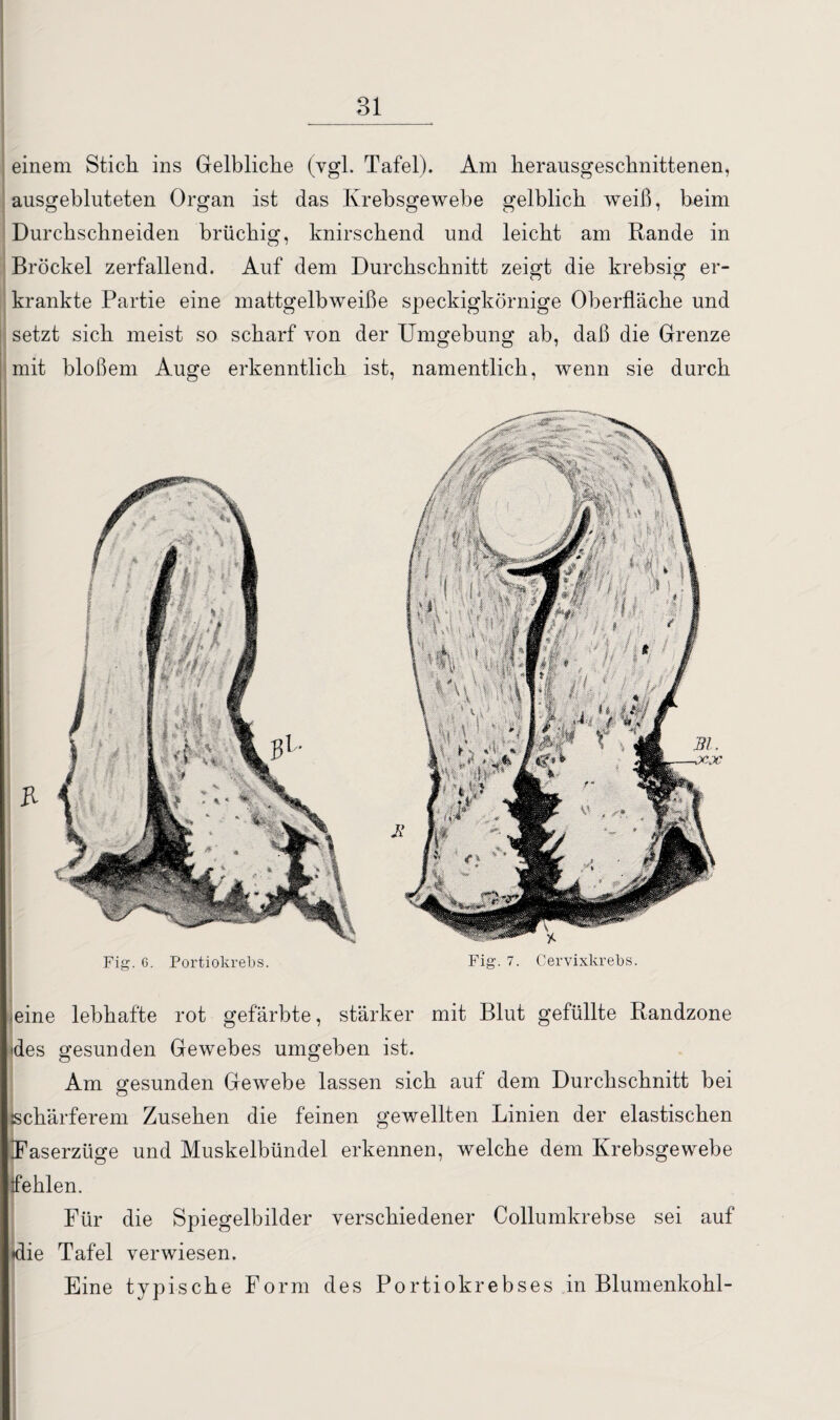 einem Stich ins Gelbliche (vgl. Tafel). Am herausgeschnittenen, ausgebluteten Organ ist das Krebsgewebe gelblich weiß, beim Durchschneiden brüchig, knirschend und leicht am Rande in Brockel zerfallend. Auf dem Durchschnitt zeigt die krebsig er¬ krankte Partie eine mattgelbweiße speckigkörnige Oberfläche und setzt sich meist so scharf von der Umgehung ab, daß die Grenze mit bloßem Auge erkenntlich ist, namentlich, wenn sie durch R Fig. 6. Portiokrebs. Fig. 7. Cervixkrebs. -eine lebhafte rot gefärbte, stärker mit Blut gefüllte Randzone <des gesunden Gewebes umgeben ist. Am gesunden Gewebe lassen sich auf dem Durchschnitt bei schärferem Zusehen die feinen gewellten Linien der elastischen Faserzüge und Muskelbündel erkennen, welche dem Krebsgewebe fehlen. Für die Spiegelbilder verschiedener Collumkrebse sei auf ♦die Tafel verwiesen. Eine typische Form des Portiokrebses in Blumenkohl-
