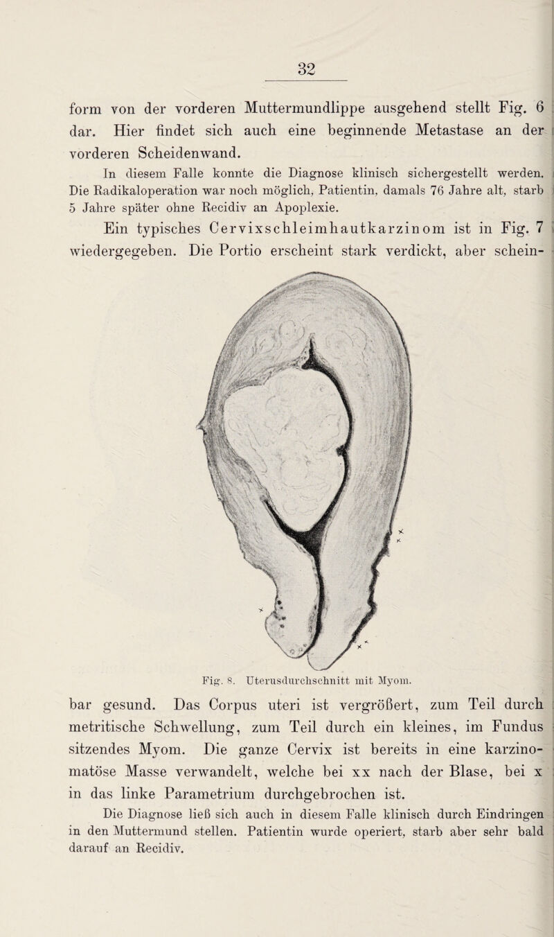 form von der vorderen Muttermundlippe ausgehend stellt Fig. 6 dar. Hier findet sich auch eine beginnende Metastase an der vorderen Scheidenwand. In diesem Falle konnte die Diagnose klinisch sichergestellt werden. Die Radikaloperation war noch möglich, Patientin, damals 76 Jahre alt, starb 5 Jahre später ohne Recidiv an Apoplexie. Ein typisches Cervixschleimhautkarzinom ist in Fig. 7 wiedergegehen. Die Portio erscheint stark verdickt, aber schein- Fig. 8. Uterusdurchschnitt mit Myom. bar gesund. Das Corpus uteri ist vergrößert, zum Teil durch metritische Schwellung, zum Teil durch ein kleines, im Fundus sitzendes Myom. Die ganze Cervix ist bereits in eine karzino- matöse Masse verwandelt, welche bei xx nach der Blase, bei x in das linke Parametrium durchgebrochen ist. Die Diagnose ließ sich auch in diesem Falle klinisch durch Eindringen in den Muttermund stellen. Patientin wurde operiert, starb aber sehr bald darauf an Recidiv.