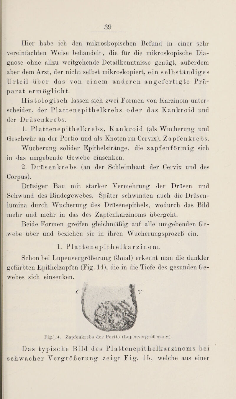 Hier habe ich den mikroskopischen Befund in einer sehr vereinfachten Weise behandelt, die für die mikroskopische Dia¬ gnose ohne allzu weitgehende Detailkenntnisse genügt, außerdem aber dem Arzt, der nicht selbst mikroskopiert, ein selbständiges Urteil über das von einem anderen angefertigte Prä¬ parat ermöglicht. Histologisch lassen sich zwei Formen von Karzinom unter¬ scheiden, der Plattenepithelkrebs oder das Kankroid und der Drüsenkrebs. 1. Plattenepithelkrebs, Kankroid (als Wucherung und Geschwür an der Portio und als Knoten im Cervix), Zapfenkrebs. Wucherung solider Epithelstränge, die zapfenförmig sich in das umgebende Gewebe einsenken. 2. Drüsenkrebs (an der Schleimhaut der Cervix und des Corpus). Drüsiger Bau mit starker Vermehrung der Drüsen und Schwund des Bindegewebes. Später schwinden auch die Drüsen¬ lumina durch Wucherung des Drüsenepithels, wodurch das Bild mehr und mehr in das des Zapfenkarzinoms übergeht. Beide Formen greifen gleichmäßig auf alle umgebenden Ge¬ webe über und beziehen sie in ihren Wucherungsprozeß ein. 1. Plattenepithelkarzinom. Schon bei Lupenvergrößerung (3mal) erkennt man die dunkler gefärbten Epithelzapfen (Fig. 14), die in die Tiefe des gesunden Ge¬ webes sich einsenken. Fig.'14. Zapfenkrebs der Portio (Lupenvergrößerung). Das typische Bild des Plattenepithelkarzinoms bei
