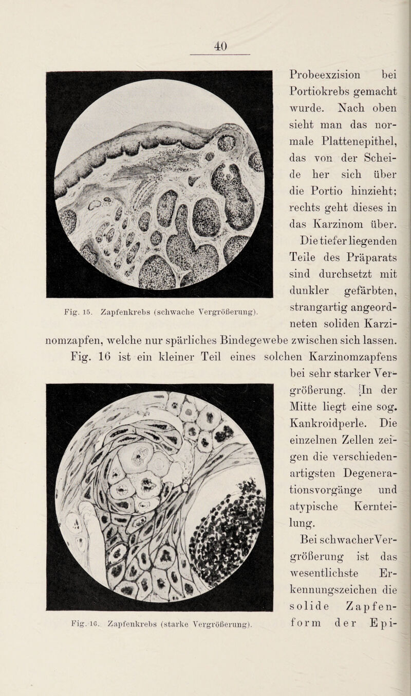 Fig. 15. Zapfenkrebs (schwache Vergrößerung) Probeexzision bei Portiokrebs gemacht wurde. Nach oben sieht man das nor¬ male Plattenepithel, das von der Schei¬ de her sich über die Portio hinzieht; rechts geht dieses in das Karzinom über. Die tiefer liegenden Teile des Präparats sind durchsetzt mit dunkler gefärbten, strangartig angeord¬ neten soliden Karzi¬ nomzapfen, welche nur spärliches Bindegewebe zwischen sich lassen. Fig. 16 ist ein kleiner Teil eines solchen Karzinomzapfens bei sehr starker Ver¬ größerung. [In der Mitte liegt eine sog. Kankroidperle. Die einzelnen Zellen zei¬ gen die verschieden¬ artigsten Degenera¬ tionsvorgänge und atypische Kerntei¬ lung. Bei schwacherVer- größerung ist das wesentlichste Er¬ kennungszeichen die solide Zapfen- Fig. 16. Zapfenkrebs (starke Vergrößerung). form der E p 1-