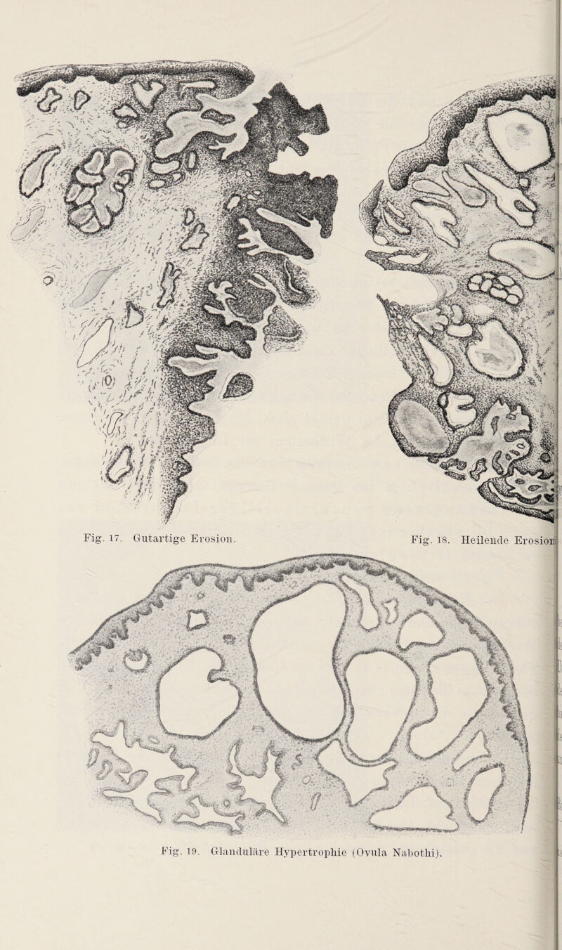 Fig. 19. Glanduläre Hypertrophie (Ovula Nabotlii)