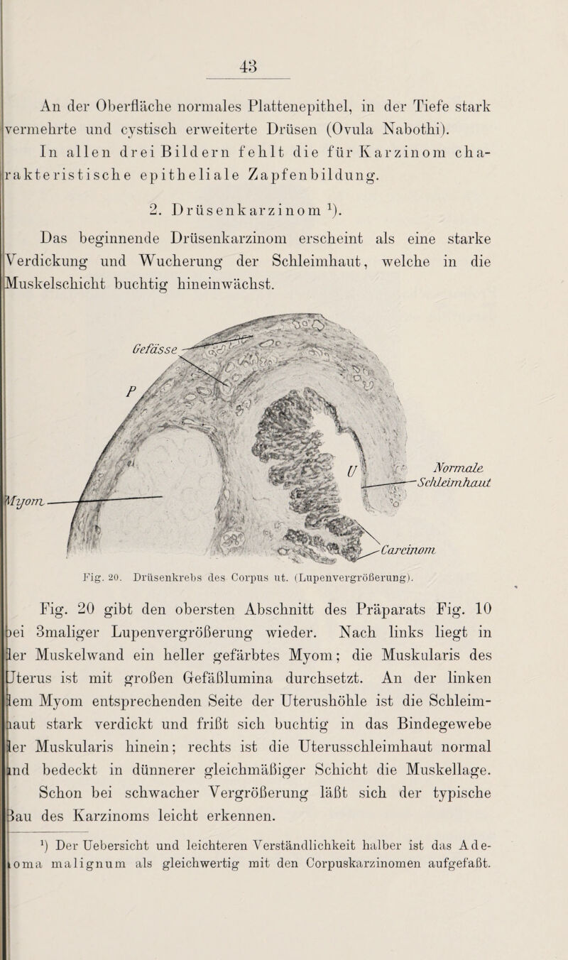 48 An der Oberfläche normales Plattenepithel, in der Tiefe stark vermehrte und cystisch erweiterte Drüsen (Ovula Nabothi). In allen drei Bildern fehlt die für Karzinom cha¬ rakteristische epitheliale Zapfenbildung. 2. Drüsenkarzinom J). Das beginnende Drüsenkarzinom erscheint als eine starke Verdickung und Wucherung der Schleimhaut, welche in die Muskelschicht buchtig hineinwächst. Fig. 20. Drüsenkrebs des Corpus ut. (Lupenvergrößerung). Fig. 20 gibt den obersten Abschnitt des Präparats Fig. 10 )ei Bmaliger Lupenvergrößerung wieder. Nach links liegt in er Muskelwand ein heller gefärbtes Myom; die Muskularis des Jterus ist mit großen Gefäßlumina durchsetzt. An der linken em Myom entsprechenden Seite der Uterushöhle ist die Schleim¬ iaut stark verdickt und frißt sich buchtig in das Bindegewebe er Muskularis hinein; rechts ist die Uterusschleimhaut normal md bedeckt in dünnerer gleichmäßiger Schicht die Muskellage. Schon bei schwacher Vergrößerung läßt sich der typische Bau des Karzinoms leicht erkennen. fl Der Uebersicht und leichteren Verständlichkeit halber ist das Ade- oma malignum als gleichwertig mit den Corpuskarzinomen aufgefaßt.