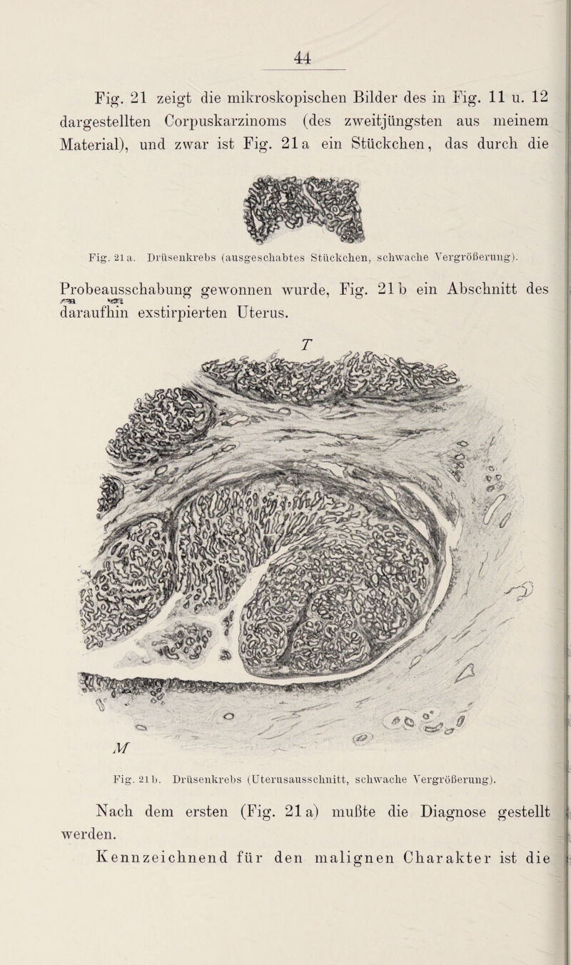 Fig. 21 zeigt die mikroskopischen Bilder des in Fig. 11 u. 12 dargestellten Corpuskarzinoms (des zweitjüngsten aus meinem Material), und zwar ist Fig. 21a ein Stückchen, das durch die Fig. 2ia. Drüsenkrebs (ausgeschabtes Stückchen, schwache Vergrößerung). Probeausschabung gewonnen wurde, Fig. 21h ein Abschnitt des daraufhin exstirpierten Uterus. T Fig. 21b. Drüsenkrebs (Uterusausschnitt, schwache Vergrößerung). Nach dem ersten (Fig. 21a) mußte die Diagnose gestellt werden. Kennzeichnend für den malignen Charakter ist die