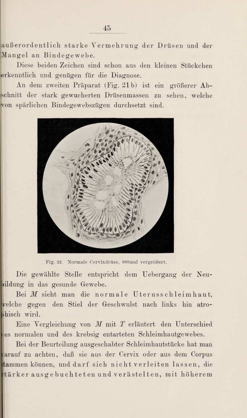 außerordentlich starke Vermehrung der Drüsen und der ^Mangel an Bindegewebe. Diese beiden Zeichen sind schon aus den kleinen Stückchen erkenntlich und genügen für die Diagnose. An dem zweiten Präparat (Fig. 21b) ist ein größerer Ab¬ schnitt der stark gewucherten Drüsenmassen zu sehen, welche von spärlichen Bindegewebszügen durchsetzt sind. Fig. 22. Normale Cervixdrüse, 800mal vergrößert. Die gewählte Stelle entspricht dem Uebergang der Neu- »ildung in das gesunde Gewebe. Bei M sieht man die normale Uteruss ch leim haut, welche gegen den Stiel der Geschwulst nach links hin atro¬ phisch wird. Eine Vergleichung von M mit T erläutert den Unterschied .es normalen und des krebsig entarteten Schleimhautgewebes. Bei der Beurteilung ausgeschabter Schleimhautstücke hat man arauf zu achten, daß sie aus der Cervix oder aus dem Corpus tammen können, und darf sich nicht verleiten lassen, die rtärker ausgebuchteten und verästelten, mit höherem