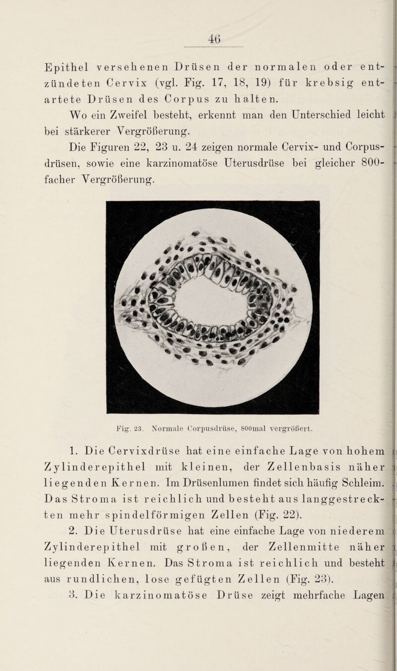 Epithel versehenen Drüsen der normalen oder ent¬ zündeten Cervix (vgl. Fig. 17, 18, 19) für krebsig ent¬ artete Drüsen des Corpus zu halten. Wo ein Zweifel besteht, erkennt man den Unterschied leicht bei stärkerer Vergrößerung. Die Figuren 22, 28 u. 24 zeigen normale Cervix- und Corpus- drüsen, sowie eine karzinomatöse Uterusdrüse hei gleicher 800- facher Vergrößerung. Fig. 23. Normale Corpusdrii.se, 800mal vergrößert. 1. Die Cervixdrüse hat eine einfache Lage von hohem Zylinderepithel mit kleinen, der Zellenbasis näher liegenden Kernen. Im Drüsenlumen findet sich häufig Schleim. Das Stroma ist reichlich und besteht aus langgestreck¬ ten mehr spindelförmigen Zellen (Fig. 22). 2. Die Uterusdrüse hat eine einfache Lage von niederem Zylinder ep ithel mit großen, der Zellenmitte näher liegenden Kernen. Das Stroma ist reichlich und besteht aus rundlichen, lose gefügten Zellen (Fig. 23). 3. Die karzinomatöse Drüse zeigt mehrfache Lagen < j o
