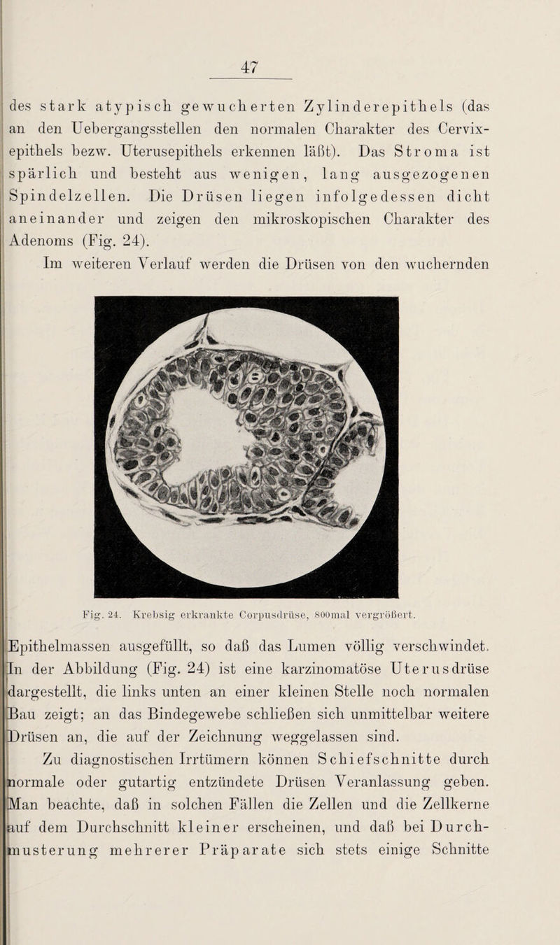 des stark atypisch gewucherten Zylinderepithels (das an den Uebergangsstellen den normalen Charakter des Cervix¬ epithels hezw. Uterusepithels erkennen läßt). Das Stroma ist spärlich und besteht aus wenigen, lang ausgezogenen Spindelzellen. Die Drüsen liegen infolgedessen dicht aneinander und zeigen den mikroskopischen Charakter des Adenoms (Fig. 24). Im weiteren Verlauf werden die Drüsen von den wuchernden Fig. 24. Krebsig erkrankte Corpusclrüse, 800mal vergrößert. Epithelmassen ausgefüllt, so daß das Lumen völlig verschwindeh In der Abbildung (Fig. 24) ist eine karzinomatöse Uterusdrüse dargestellt, die links unten an einer kleinen Stelle noch normalen Bau zeigt; an das Bindegewebe schließen sich unmittelbar weitere Drüsen an, die auf der Zeichnung weggelassen sind. Zu diagnostischen Irrtümern können Schiefschnitte durch normale oder gutartig entzündete Drüsen Veranlassung geben. Man beachte, daß in solchen Fällen die Zellen und die Zellkerne auf dem Durchschnitt kleiner erscheinen, und daß bei Durch¬ musterung mehrerer Präparate sich stets einige Schnitte