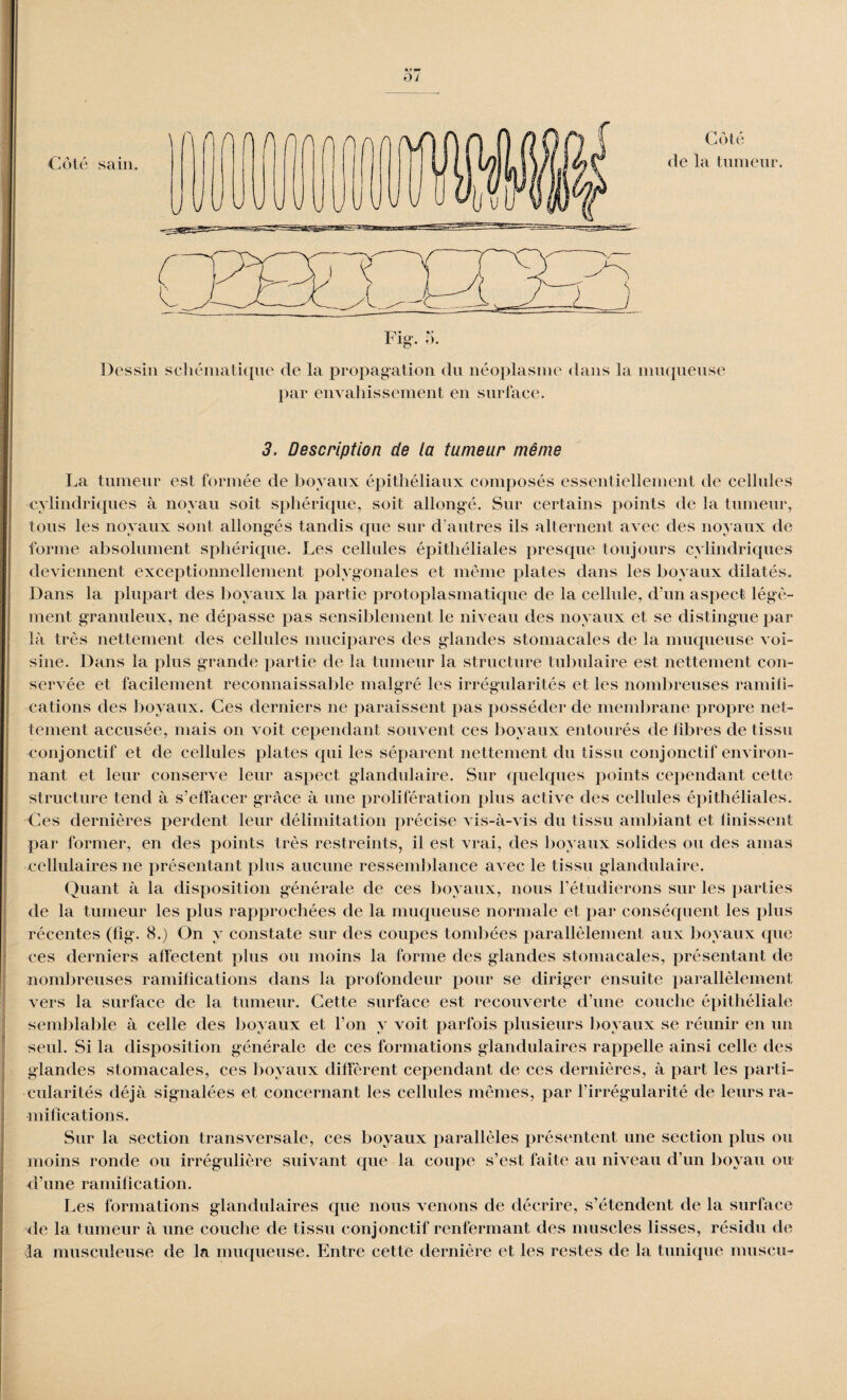 O J Coté sain. Côté de la tumeur Dessin schématique de la propagation du néoplasme dans la muqueuse par envahissement en surface. 3. Description de la tumeur même La tumeur est formée de boyaux épithéliaux composés essentiellement de cellules cylindriques à noyau soit sphérique, soit allongé. Sur certains points de la tumeur, tous les noyaux sont allongés tandis que sur d'autres ils alternent avec des noyaux de forme absolument sphérique. Les cellules épithéliales presque toujours cylindriques deviennent exceptionnellement polygonales et même plates dans les boyaux dilatés. Dans la plupart des boyaux la partie protoplasmatique de la cellule, d’un aspect légè- ment granuleux, ne dépasse pas sensiblement le niveau des noyaux et se distingue par là très nettement des cellules mucipares des glandes stomacales de la muqueuse voi¬ sine. Dans la plus grande partie de la tumeur la structure tubulaire est nettement con¬ servée et facilement reconnaissable malgré les irrégularités et les nombreuses ramili- cations des boyaux. Ces derniers ne paraissent pas posséder de membrane propre net¬ tement accusée, mais on voit cependant souvent ces boyaux entourés de libres de tissu conjonctif et de cellules plates qui les séparent nettement du tissu conjonctif environ¬ nant et leur conserve leur aspect glandulaire. Sur quelques points cependant cette structure tend à s’effacer grâce à une prolifération plus active des cellules épithéliales. Ces dernières perdent leur délimitation précise vis-à-vis du tissu ambiant et finissent par former, en des points très restreints, il est vrai, des boyaux solides ou des amas cellulaires ne présentant plus aucune ressemblance avec le tissu glandulaire. Quant à la disposition générale de ces boyaux, nous l’étudierons sur les parties de la tumeur les plus rapprochées de la muqueuse normale et par conséquent les plus récentes (fig. 8.) On y constate sur des coupes tombées parallèlement aux boyaux que ces derniers affectent plus ou moins la forme des glandes stomacales, présentant de nombreuses ramifications dans la profondeur pour se diriger ensuite parallèlement vers la surface de la tumeur. Cette surface est recouverte d’une couche épithéliale semblable à celle des boyaux et l’on y voit parfois plusieurs boyaux se réunir en un seul. Si la disposition générale de ces formations glandulaires rappelle ainsi celle des glandes stomacales, ces boyaux diffèrent cependant de ces dernières, à part les parti¬ cularités déjà signalées et concernant les cellules mêmes, par l’irrégularité de leurs ra¬ mifications. Sur la section transversale, ces boyaux parallèles présentent une section plus ou moins ronde ou irrégulière suivant que la coupe s’est faite au niveau d’un boyau ou d’une ramification. Les formations glandulaires que nous venons de décrire, s’étendent de la surface de la tumeur à une couche de tissu conjonctif renfermant des muscles lisses, résidu de da musculeuse de la muqueuse. Entre cette dernière et les restes de la tunique muscu-