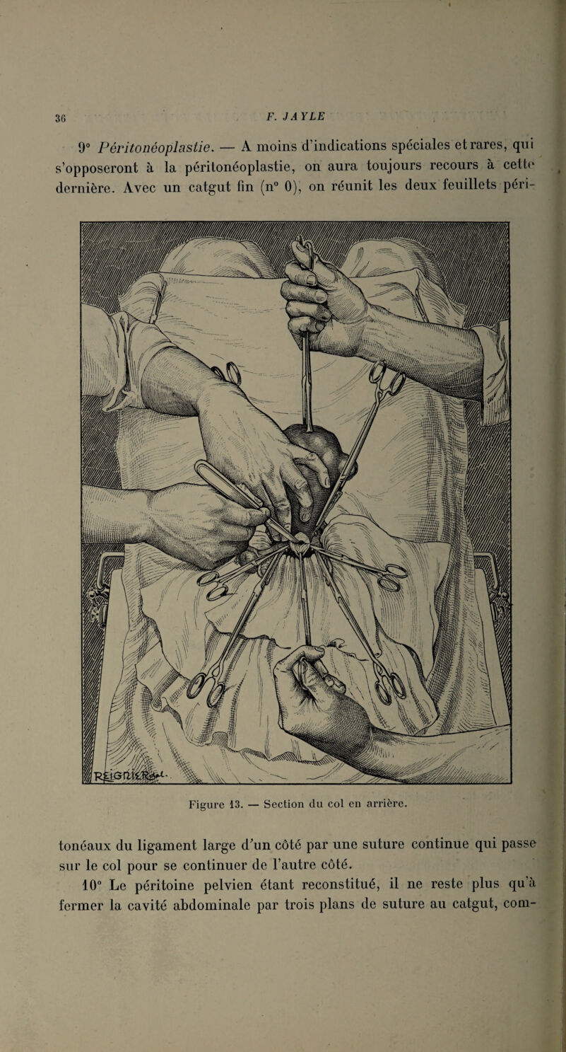 9° Péritonéoplastie. — A moins d’indications spéciales et rares, qui s’opposeront à la péritonéoplastie, on aura toujours recours à cette dernière. Avec un catgut fin (n° 0), on réunit les deux feuillets péri- Figure 13. — Section du col en arrière. tonéaux du ligament large d\m côté par une suture continue qui passe sur le col pour se continuer de l’autre côté. 10° Le péritoine pelvien étant reconstitué, il ne reste plus qu a fermer la cavité abdominale par trois plans de suture au catgut, com-