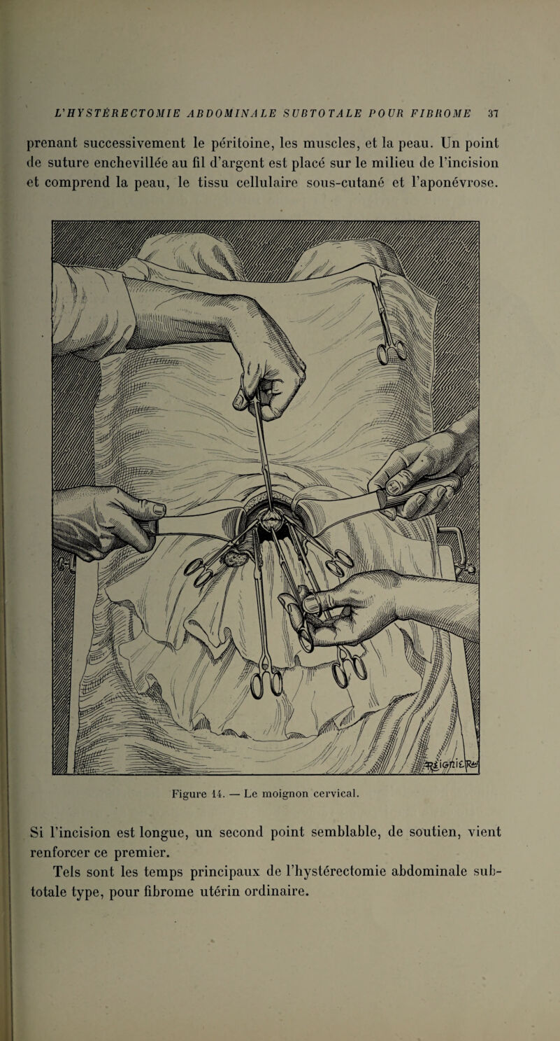 prenant successivement le péritoine, les muscles, et la peau. Un point cle suture enchevillée au fil d’argent est placé sur le milieu de l’incision et comprend la peau, le tissu cellulaire sous-cutané et l’aponévrose. Si l’incision est longue, un second point semblable, de soutien, vient renforcer ce premier. Tels sont les temps principaux de l’hystérectomie abdominale sub¬ totale type, pour fibrome utérin ordinaire.