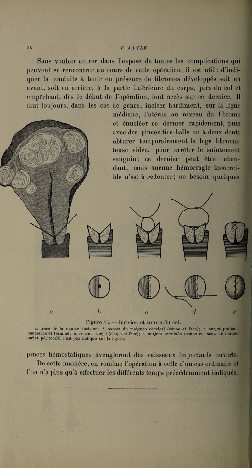 Sans vouloir entrer dans l’exposé de toutes les complications qui peuvent se rencontrer au cours de cette opération, il est utile d’indi¬ quer la conduite à tenir en présence de fibromes développés soit en avant, soit en arrière, à la partie inférieure du corps, près du col et empêchant, dès le début de l’opération, tout accès sur ce dernier. Il faut toujours, dans les cas de genre, inciser hardiment, sur la ligne médiane, l’utérus au niveau du fibrome et énucléer ce dernier rapidement, puis avec des pinces tire-balle ou à deux dents obturer temporairement la loge fibroma¬ teuse vidée, pour arrêter le suintement sanguin ; ce dernier peut être abon¬ dant, mais aucune hémorragie incoerci¬ ble n’est à redouter; au besoin, quelques Figure 15. — Incision et suture du col. a, tracé de la double incision; b, aspect du moignon cervical (coupe et face); c, surjet profond, commencé et terminé; d, second surjet (coupe et face); e, surjets terminés (coupe et face). Le dernier surjet péritonéal n’est pas indiqué sur la figure. pinces hémostatiques aveugleront des vaisseaux importants ouverts. De cette manière, on ramène l’opération à celle d’un cas ordinaire et f on n’a plus qu a effectuer les différents temps précédemment indiqués. i