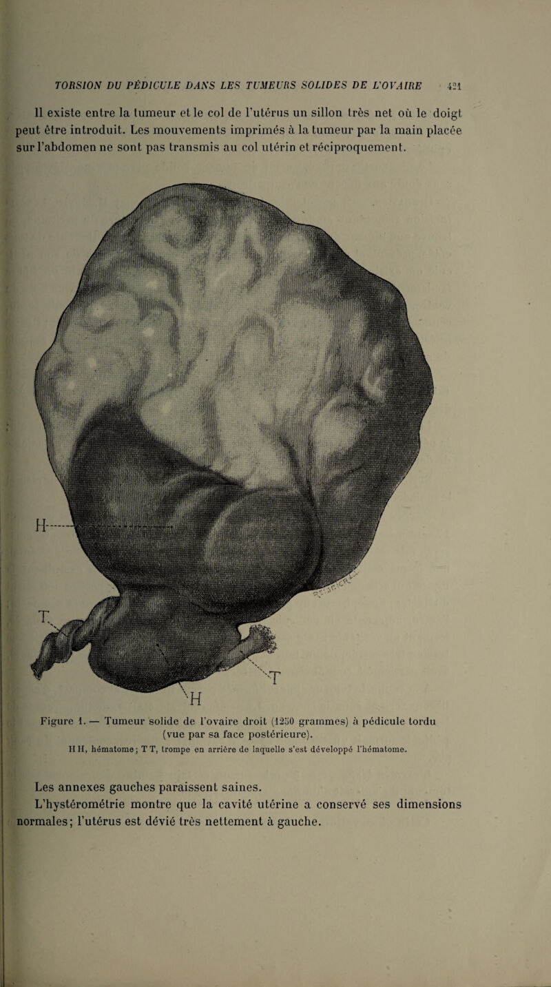 11 existe entre la tumeur et le col de Futériis un sillon très net où le doigt peut être introduit. Les mouvements imprimés à la tumeur par la main placée sur l’abdomen ne sont pas transmis au col utérin et réciproquement. Figure 1. — Tumeur solide de l’ovaire droit (1250 grammes) à pédicule tordu (vue par sa face postérieure). HH, hématome; TT, trompe en arrière de laquelle s’est développé l’hématome. Les annexes gauches paraissent saines. j L’hystérométrie montre que la cavité utérine a conservé ses dimensions I normales; l’utérus est dévié très nettement à gauche.