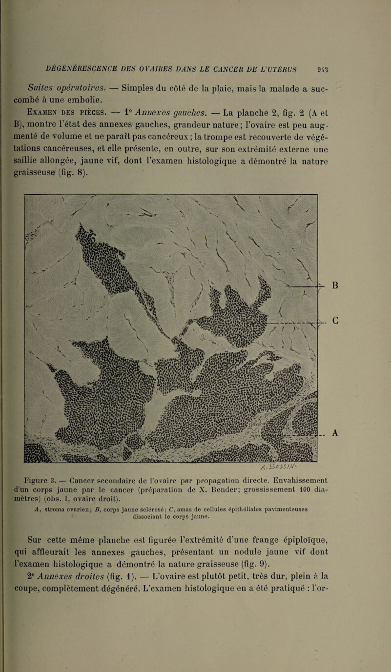 Suites opératoires. — Simples du côté de la plaie, mais la malade a suc¬ combé à une embolie. Examen des pièces. — i” Annexes gauches. — La planche 2, fig. 2 (A et B), montre l’état des annexes gauches, grandeur nature; l’ovaire est peu aug¬ menté de volume et ne paraît pas cancéreux ; la trompe est recouverte de végé¬ tations cancéreuses, et elle présente, en outre, sur son extrémité externe une saillie allongée, jaune vif, dont l’examen histologique a démontré la nature graisseuse (fig. 8). Figure 3. — Cancer secondaire de l’ovaire par propagation directe. Envahissement d’un corps jaune par le cancer (préparation de X. Bender; grossissement 100 dia¬ mètres) (obs. I, ovaire droit). A, stroma ovarien; B, corps jaune sclérosé; C, amas de cellules épithéliales pavimenteuses dissociant le corps jaune. s-£mm m Sur cette même planche est figurée l’extrémité d’une frange épiploïque, qui affleurait les annexes gauches, présentant un nodule jaune vif dont l’examen histologique a démontré la nature graisseuse (fig. 9). 2° Annexes droites (fîg. 1). — L’ovaire est plutôt petit, très dur, plein a la coupe, complètement dégénéré. L’examen histologique en a été pratiqué : for-