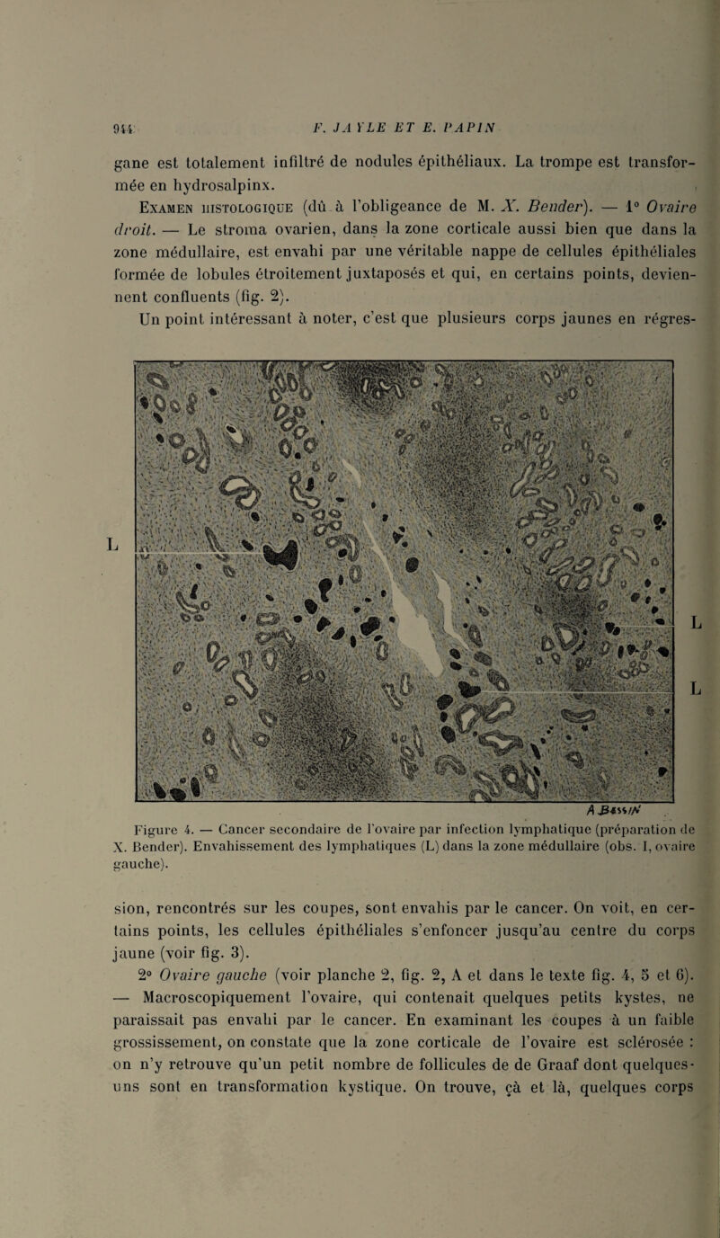 gane est totalement infiltré de nodules épithéliaux. La trompe est transfor¬ mée en hydrosalpinx. Examen histologique (dû à l’obligeance de M. X. Bender). — 1° Ovaire droit. — Le stroma ovarien, dans la zone corticale aussi bien que dans la zone médullaire, est envahi par une véritable nappe de cellules épithéliales formée de lobules étroitement juxtaposés et qui, en certains points, devien¬ nent confluents (fig. 2). Un point intéressant à noter, c’est que plusieurs corps jaunes en régres- Figure 4. — Cancer secondaire de l’ovaire par infection lymphatique (préparation de X. Bender). Envahissement des lymphatiques (L) dans la zone médullaire (obs. I, ovaire gauche). sion, rencontrés sur les coupes, sont envahis par le cancer. On voit, en cer¬ tains points, les cellules épithéliales s’enfoncer jusqu’au centre du corps jaune (voir fig. 3). 2° Ovaire gauche (voir planche 2, fig. 2, A et dans le texte fig. 4, 5 et 6). — Macroscopiquement l’ovaire, qui contenait quelques petits kystes, ne paraissait pas envahi par le cancer. En examinant les coupes à un faible grossissement, on constate que la zone corticale de l’ovaire est sclérosée : on n’y retrouve qu’un petit nombre de follicules de de Graaf dont quelques- uns sont en transformation kystique. On trouve, çà et là, quelques corps