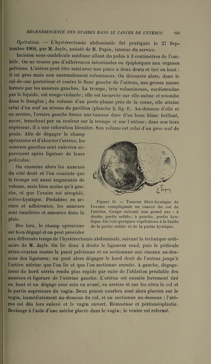 Opération. — L’hyslérectomie abdominale fut pratiquée le 27 Sep¬ tembre 1904, par M. Jayle, assisté de M. Papin, interne du service. Incision sous-ombilicale médiane allant du pubis à 3 centimètres de Pom- bilic. On ne trouve pas d’adhérences intestinales ou épiploïques aux organes pelviens. L utérus peut être saisi avec une pince à deux dents et tiré en haut : il est gros mais non anormalement volumineux. On découvre alors, dans le cul-de-sac postérieur et contre le flanc gauche de l’utérus, une grosse masse formée par les annexes gauches. La trompe, très volumineuse, surdistendue par le liquide, est rouge-violacée ; elle est incurvée sur elle-même et retombe dans le Douglas ; du volume d’un porte-plume près de la corne, elle atteint celui d’un œuf au niveau du pavillon (planche 2, fig. 1). Au-dessous d'elle et en arrière, l’ovaire gauche forme une tumeur dure d’un beau blanc brillant, nacré, tranchant par sa couleur sur la trompe et sur l’utérus; dans son tiers supérieur, il a une coloration bleuâtre. Son volume est celui d’un gros œuf de poule. Afin de dégager le champ opératoire et d’aborder l’utérus, les annexes gauches sont enlevées sé¬ parément après ligature de leurs pédicules. On examine alors les annexes du côté droit et l’on constate que la trompe est aussi augmentée de volume, mais bien moins qu’à gau¬ che, et que l’ovaire est atrophié, scléro-kystique. Prolabées en ar¬ rière et adhérentes, les annexes sont énucléées et amenées dans la plaie. Dès lors, le champ opéraloire est bien dégagé et on peut procéder aux différents temps de l’hystérectomie abdominale, suivant la technique ordi¬ naire de M. Jayle. On lie donc à droite le ligament rond, puis le pédicule utéro-ovarien contre la paroi pelvienne et on sectionnne aux ciseaux au-des¬ sous des ligatures; on peut alors dégager le bord droit de l’utérus jusqu’à l’artère utérine que l’on lie et que l’on sectionne ensuite. A gauche, dégage¬ ment du bord utérin rendu plus rapide par suite de l’ablation préalable des annéxes et ligature de l’utérine gauche. L’utérus est ensuite fortement tiré en haut et on dégage avec soin en avant, en arrière et sur les côtés le col et la partie supérieure du vagin. Deux pinces courbes sont alors placées sur le vagin, immédiatement au-dessous du col, et on sectionne au-dessous : l’uté- nis est dès lors enlevé et le vagin ouvert. Hémostase et péritonéoplastie. Drainage à l’aide d’une mèche placée dans le vagin ; le ventre est refermé. Figure 16. — Tumeur fibro-kystique de l’ovaire compliquant un cancer du col de l’utérus. Coupe suivant son grand axe : à droite, partie solide ; à gauche, partie kys¬ tique. On voit quelques végétations à la limite de la partie solide et de la partie kystique.