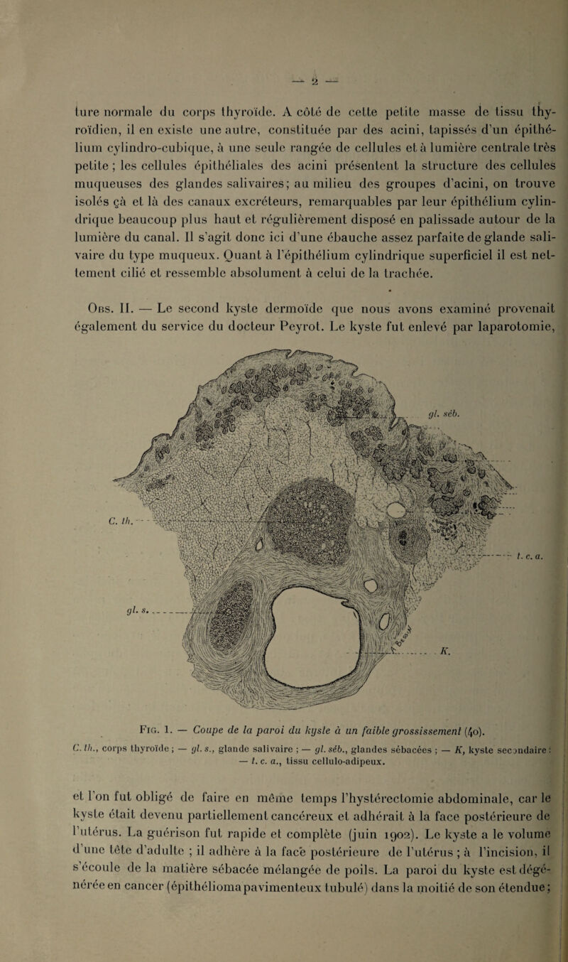 ture normale du corps thyroïde. A côté de cette petite masse de tissu thy¬ roïdien, il en existe une autre, constituée par des acini, tapissés d’un é lium cylindro-cubique, à une seule rangée de cellules et à lumière centrale très petite ; les cellules épithéliales des acini présentent la structure des cellules muqueuses des glandes salivaires; au milieu des groupes d’acini, on trouve isolés çà et là des canaux excréteurs, remarquables par leur épithélium cylin¬ drique beaucoup plus haut et régulièrement disposé en palissade autour de la lumière du canal. Il s’agit donc ici d’une ébauche assez parfaite de glande sali¬ vaire du type muqueux. Quant à l’épithélium cylindrique superficiel il est net¬ tement cilié et ressemble absolument à celui de la trachée. Obs. II. — Le second kyste dermoïde que nous avons examiné provenait également du service du docteur Peyrot. Le kyste fut enlevé par laparotomie, Fig. 1. — Coupe de la paroi du kyste à un faible grossissement (4o). C. llu, corps thyroïde ; — gl. s., glande salivaire ; — gl. séb., glandes sébacées ; — K, kyste secondaire ; — t. c. a., tissu cellulo-adipeux. et l’on fut obligé de faire en même temps l’hystérectomie abdominale, car le kyste était devenu partiellement cancéreux et adhérait à la face postérieure de l’utérus. La guérison fut rapide et complète (juin 1902). Le kyste a le volume d une tête d’adulte ; il adhère à la face postérieure de l’utérus ; à l’incision, il s écoule de la matière sébacée mélangée de poils. La paroi du kyste est dégé¬ nérée en cancer (épithéliomapavimenteux tubulé) dans la moitié de son étendue;