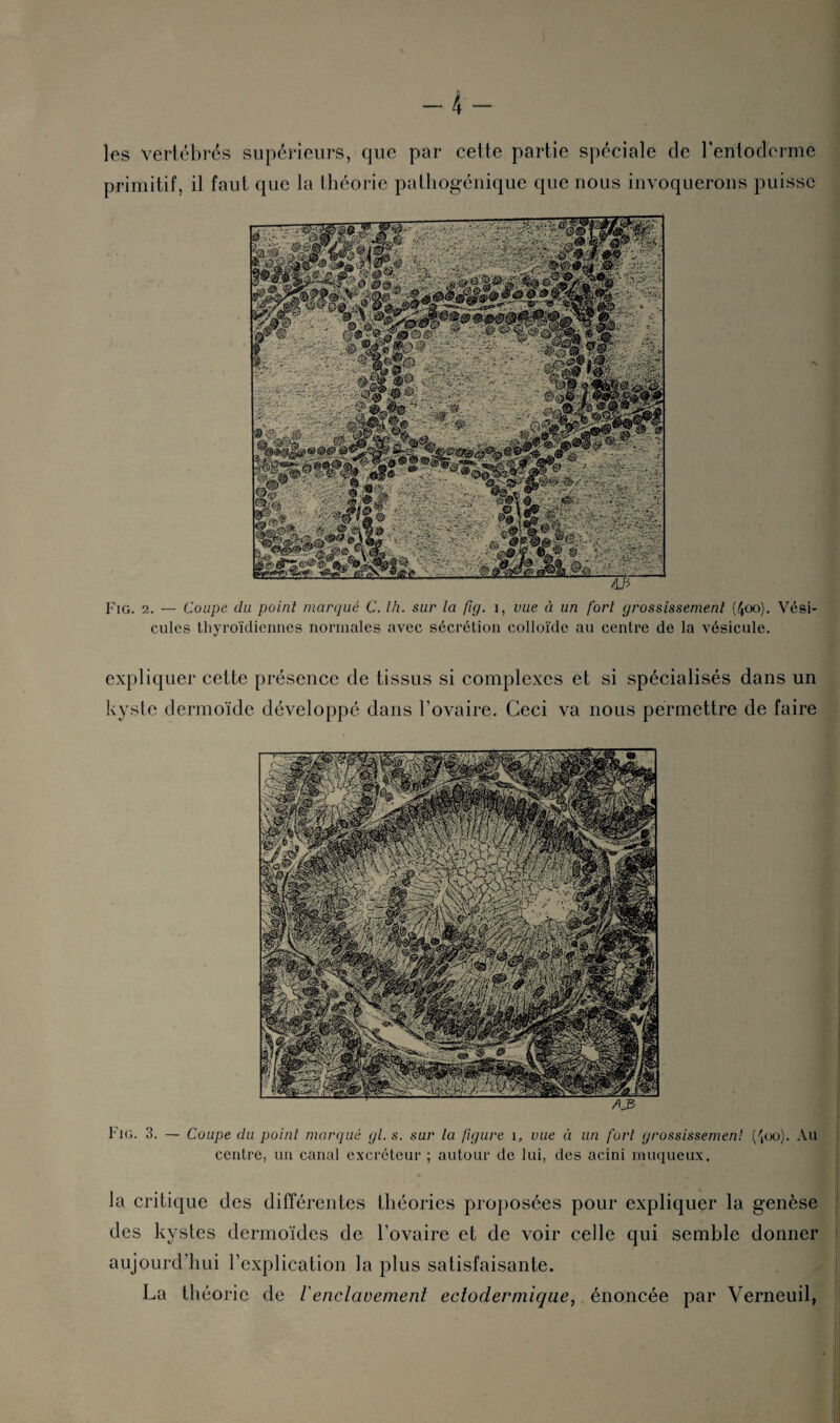 les vertébrés supérieurs, que par cette partie spéciale de l’entoderme primitif, il faut que la théorie pathogénique que nous invoquerons puisse Fig. 2. — Coupe du point marqué C. th. sur la fig. 1, vue à un fort grossissement (4oo). Vési¬ cules thyroïdiennes normales avec sécrétion colloïde au centre de la vésicule. expliquer cette présence de tissus si complexes et si spécialisés dans un kyste dermoïde développé dans l’ovaire. Ceci va nous permettre de faire A3 Fig. 3. — Coupe du point marqué gl. s. sur la figure 1, vue à un fort grossissement (\oo). Au centre, un canal excréteur ; autour de lui, des acini muqueux. la critique des différentes théories proposées pour expliquer la genèse des kystes dermoïdes de l’ovaire et de voir celle qui semble donner aujourd’hui l’explication la plus satisfaisante. La théorie de Venclavement ectoderinique, énoncée par Verneuil,