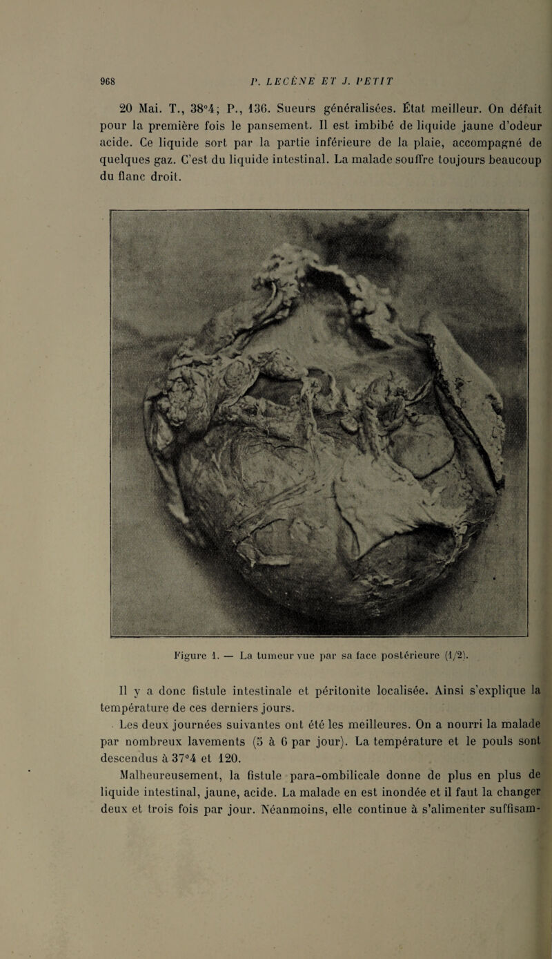 20 Mai. T., 38°4; P., 136. Sueurs généralisées. État meilleur. On défait pour la première fois le pansement. Il est imbibé de liquide jaune d’odeur acide. Ce liquide sort par la partie inférieure de la plaie, accompagné de quelques gaz. C’est du liquide intestinal. La malade souffre toujours beaucoup du flanc droit. Figure 1. — La tumeur vue par sa face postérieure (1/2). Il y a donc fistule intestinale et péritonite localisée. Ainsi s’explique la température de ces derniers jours. Les deux journées suivantes ont été les meilleures. On a nourri la malade par nombreux lavements (3 à G par jour). La température et le pouls sont descendus à 37°4 et 120. Malheureusement, la fistule para-ombilicale donne de plus en plus de liquide intestinal, jaune, acide. La malade en est inondée et il faut la changer deux et trois fois par jour. Néanmoins, elle continue à s’alimenter suffisam-