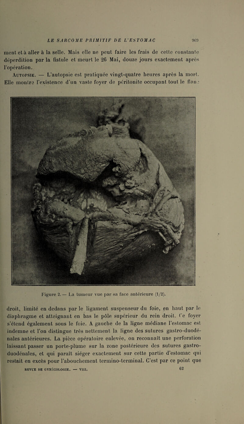 ment et à aller à la selle. Mais elle ne peut faire les frais de cetlc constante déperdition par la fistule et meurt le 2G Mai, douze jours exactement après l’opération. Autopsie. — L’autopsie est pratiquée vingt-quatre heures après la mort. Elle montre l’existence d’un vaste foyer de péritonite occupant tout le flan * Figure 2. — La tumeur vue par sa face antérieure (1/2). droit, limité en dedans par le ligament suspenseur du foie, pn haut par le diaphragme et atteignant en bas le pôle supérieur du rein droit. Te foyer s’étend également sous le foie. A gauche de la ligne médiane l’estomac est indemne et l’on distingue très nettement la ligne des sutures gastro-duodé- nales antérieures. La pièce opératoire enlevée, on reconnaît une perforation laissant passer un porte-plume sur la zone postérieure des sutures gastro- duodénales, et qui paraît siéger exactement sur cette partie d’estomac qui restait en excès pour l’abouchement termino-terminal. C’est par ce point que REVUE DE GYNÉCOLOGIE. — VIII. 62