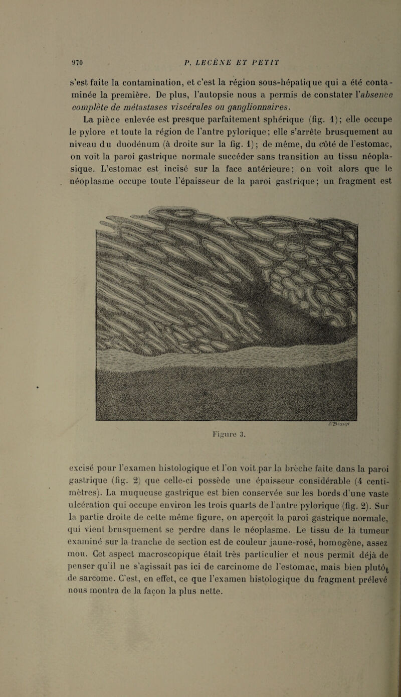 s’est faite la contamination, et c’est la région sous-hépatique qui a été conta¬ minée la première. De plus, l’autopsie nous a permis de constater Yabsence complète de métastases viscérales ou ganglionnaires. La pièce enlevée est presque parfaitement sphérique (fig. 1); elle occupe le pylore et toute la région de l’antre pylorique; elle s’arrête brusquement au niveau du duodénum (à droite sur la fig. 1); de même, du cbté de l’estomac, on voit la paroi gastrique normale succéder sans transition au tissu néopla¬ sique. L’estomac est incisé sur la face antérieure; on voit alors que le néoplasme occupe toute l’épaisseur de la paroi gastrique; un fragment est excisé pour l’examen histologique et l’on voit par la brèche faite dans la paroi gastrique (fig. 2) que celle-ci possède une épaisseur considérable (4 centi¬ mètres). La muqueuse gastrique est bien conservée sur les bords d’une vaste ulcération qui occupe environ les trois quarts de l’antre pylorique (fig. 2). Sur la partie droite de cette même figure, on aperçoit la paroi gastrique normale, qui vient brusquement se perdre dans le néoplasme. Le tissu de la tumeur examiné sur la tranche de section est de couleur jaune-rosé, homogène, assez mou. Cet aspect macroscopique était très particulier et nous permit déjà de penser qu’il ne s’agissait pas ici de carcinome de l’estomac, mais bien plutô^ de sarcome. C’est, en effet, ce que l’examen histologique du fragment prélevé nous montra de la façon la plus nette.